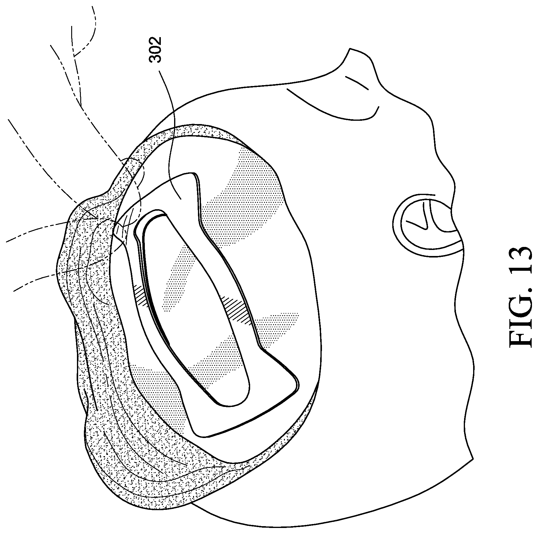 Patent US12569655 Figure 9 – Cerebral spinal fluid shunt plug