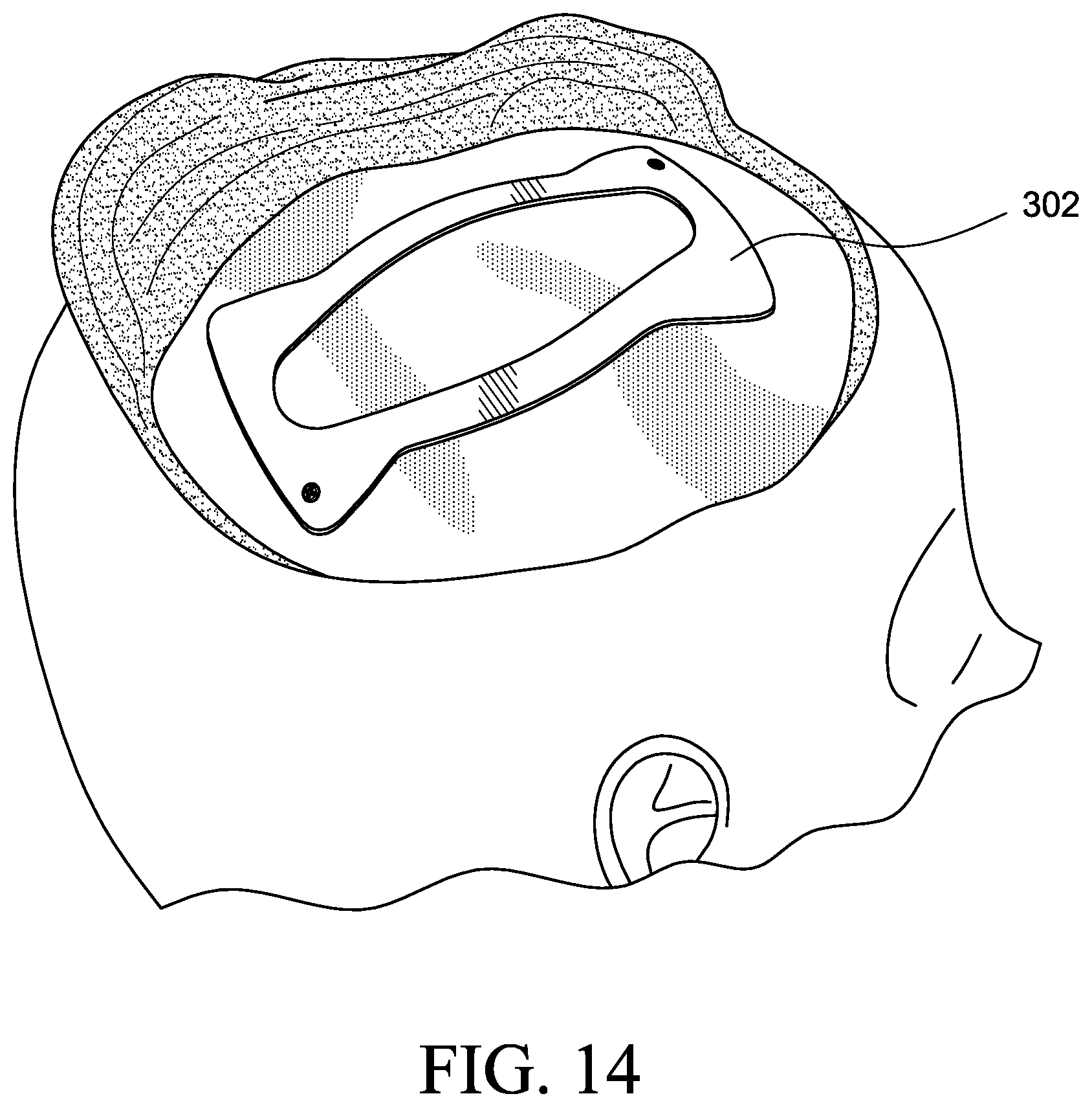 Patent US12569655 Figure 10 – Cerebral spinal fluid shunt plug