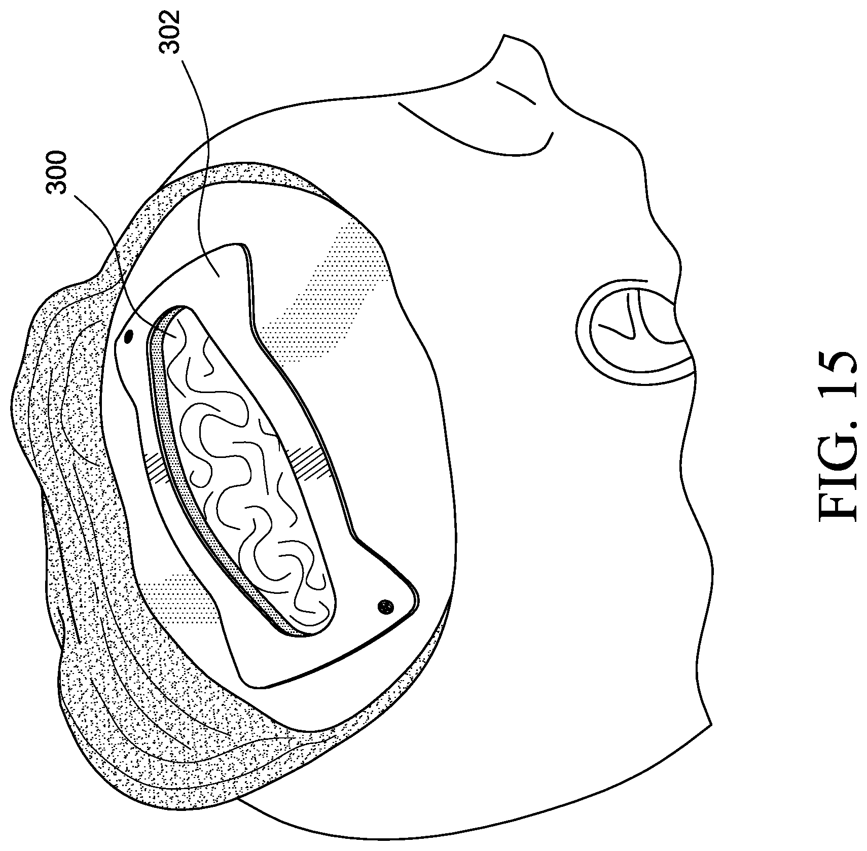 Patent US12569655 Figure 11 – Cerebral spinal fluid shunt plug