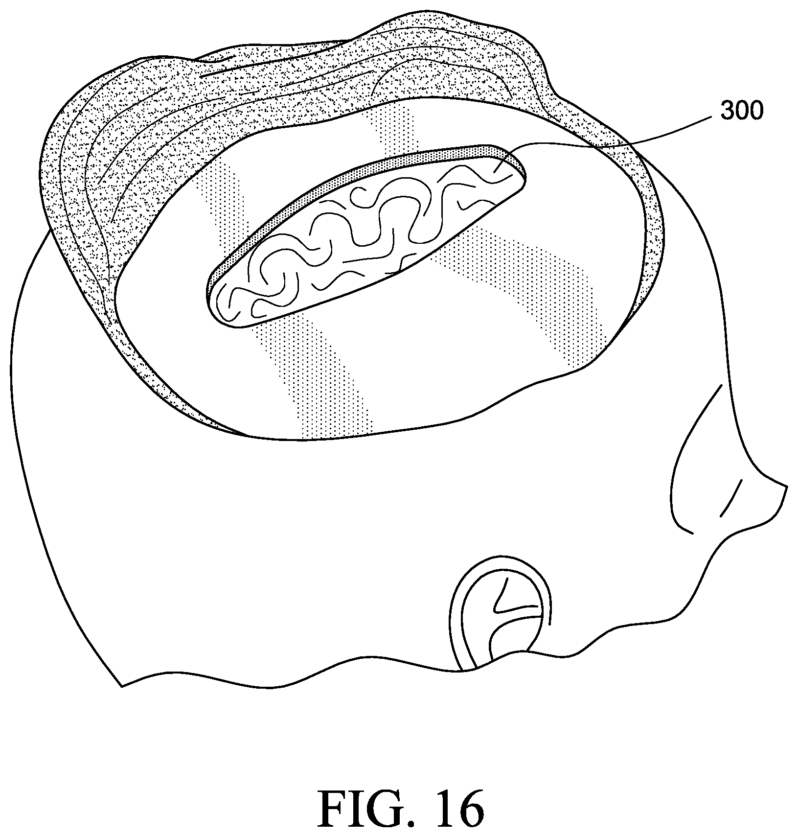 Patent US12569655 Figure 12 – Cerebral spinal fluid shunt plug