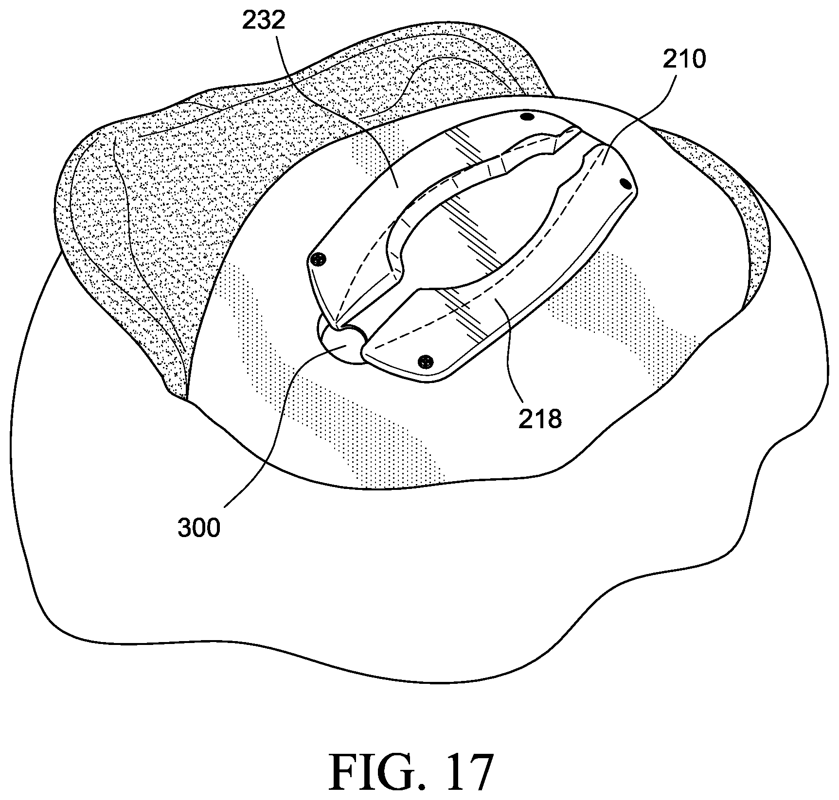 Patent US12569655 Figure 13 – Cerebral spinal fluid shunt plug