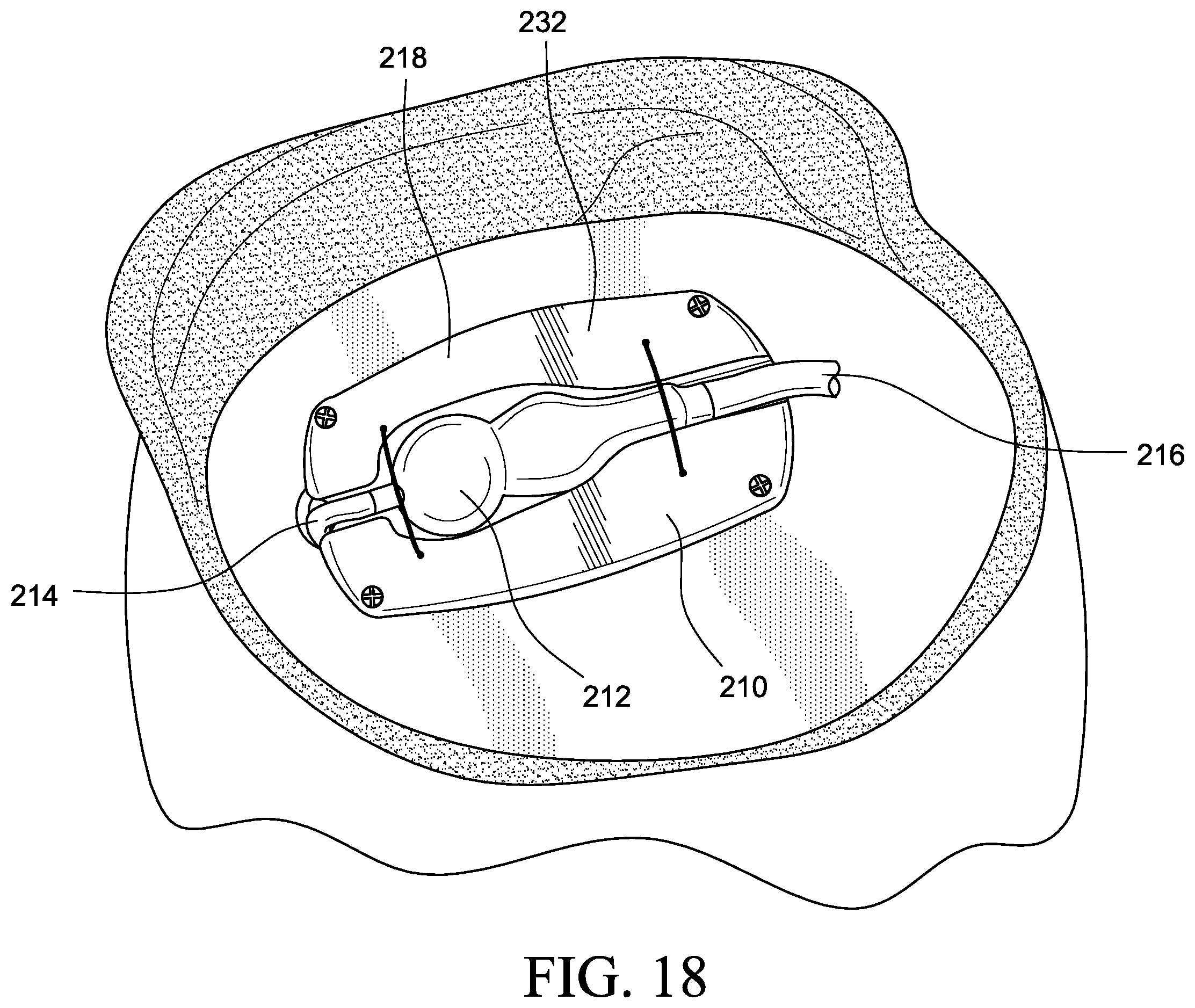 Patent US12569655 Figure 14 – Cerebral spinal fluid shunt plug