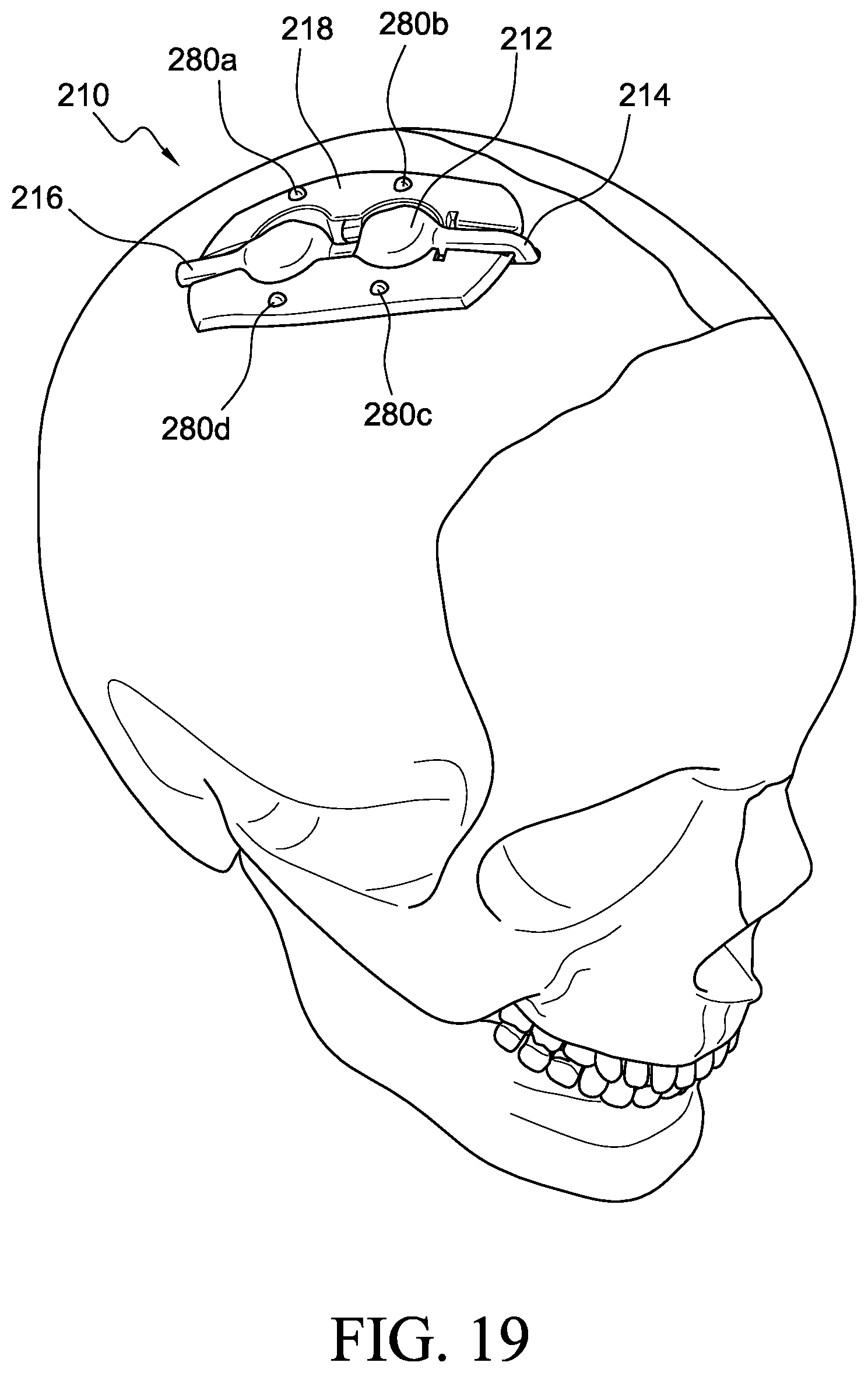 Patent US12569655 Figure 15 – Cerebral spinal fluid shunt plug