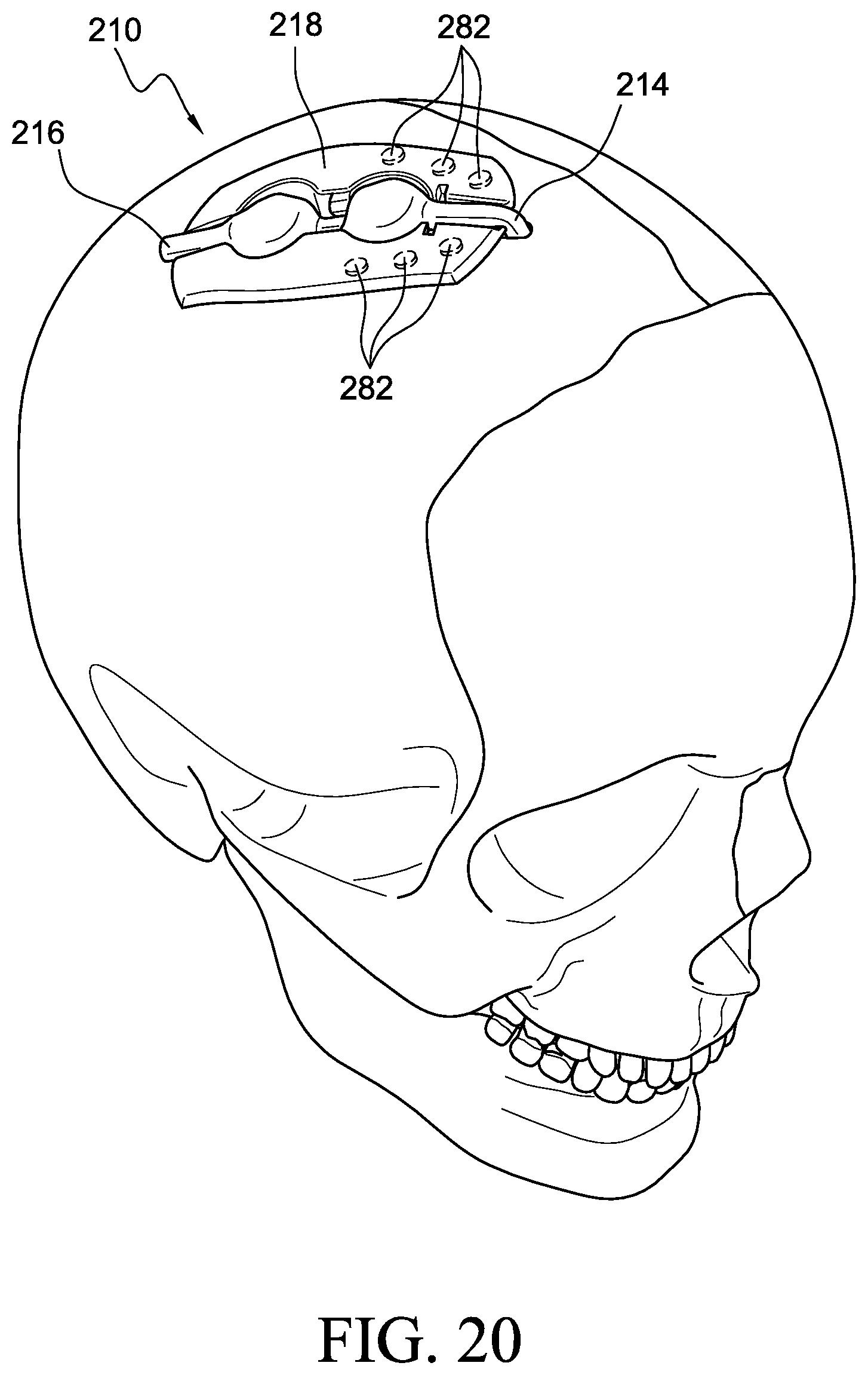 Patent US12569655 Figure 16 – Cerebral spinal fluid shunt plug