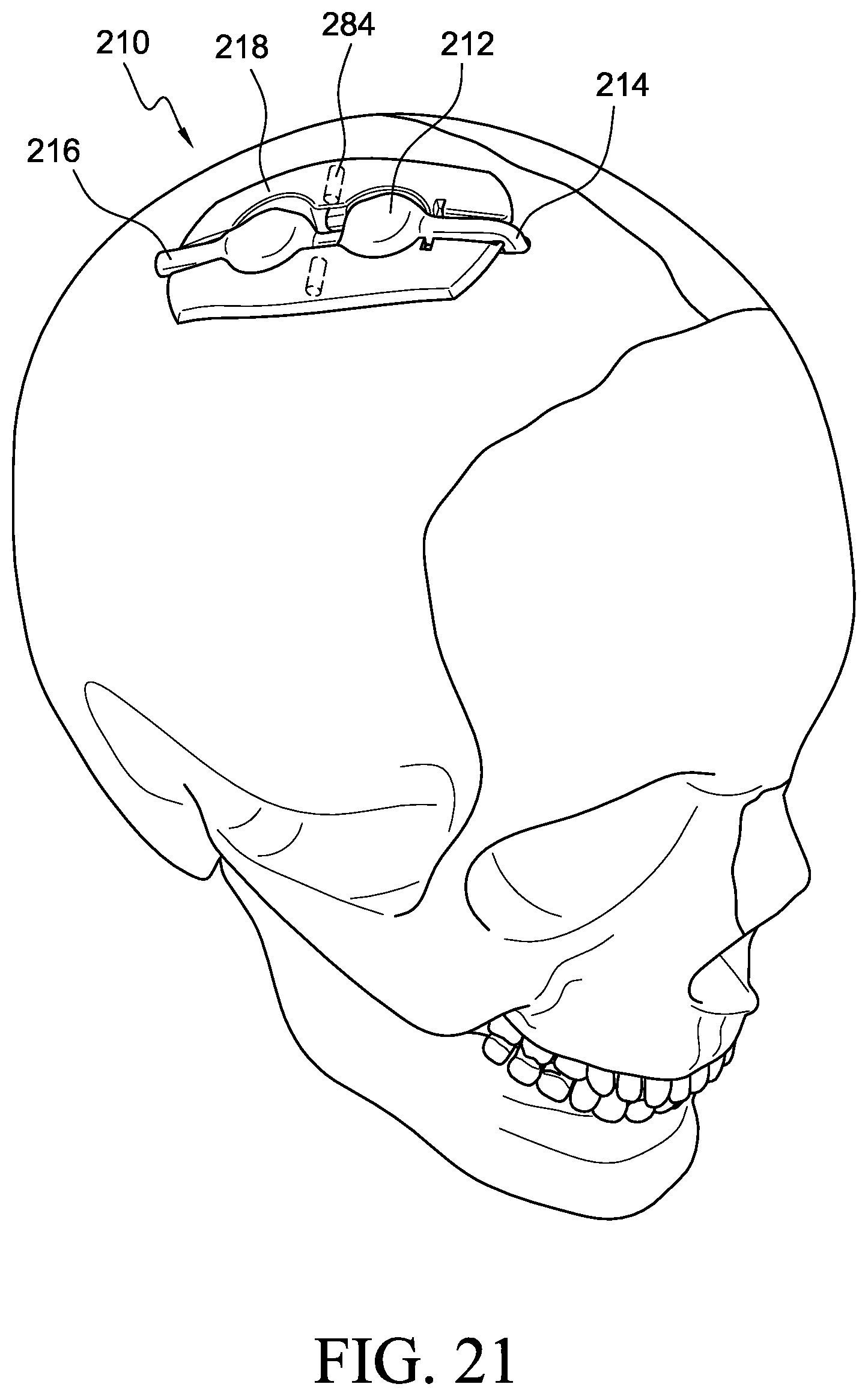 Patent US12569655 Figure 17 – Cerebral spinal fluid shunt plug