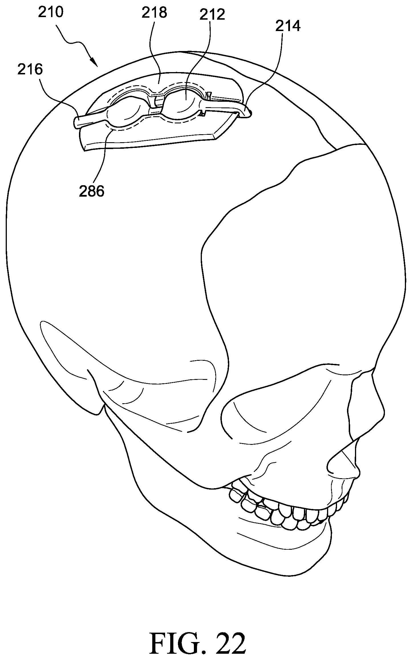 Patent US12569655 Figure 18 – Cerebral spinal fluid shunt plug