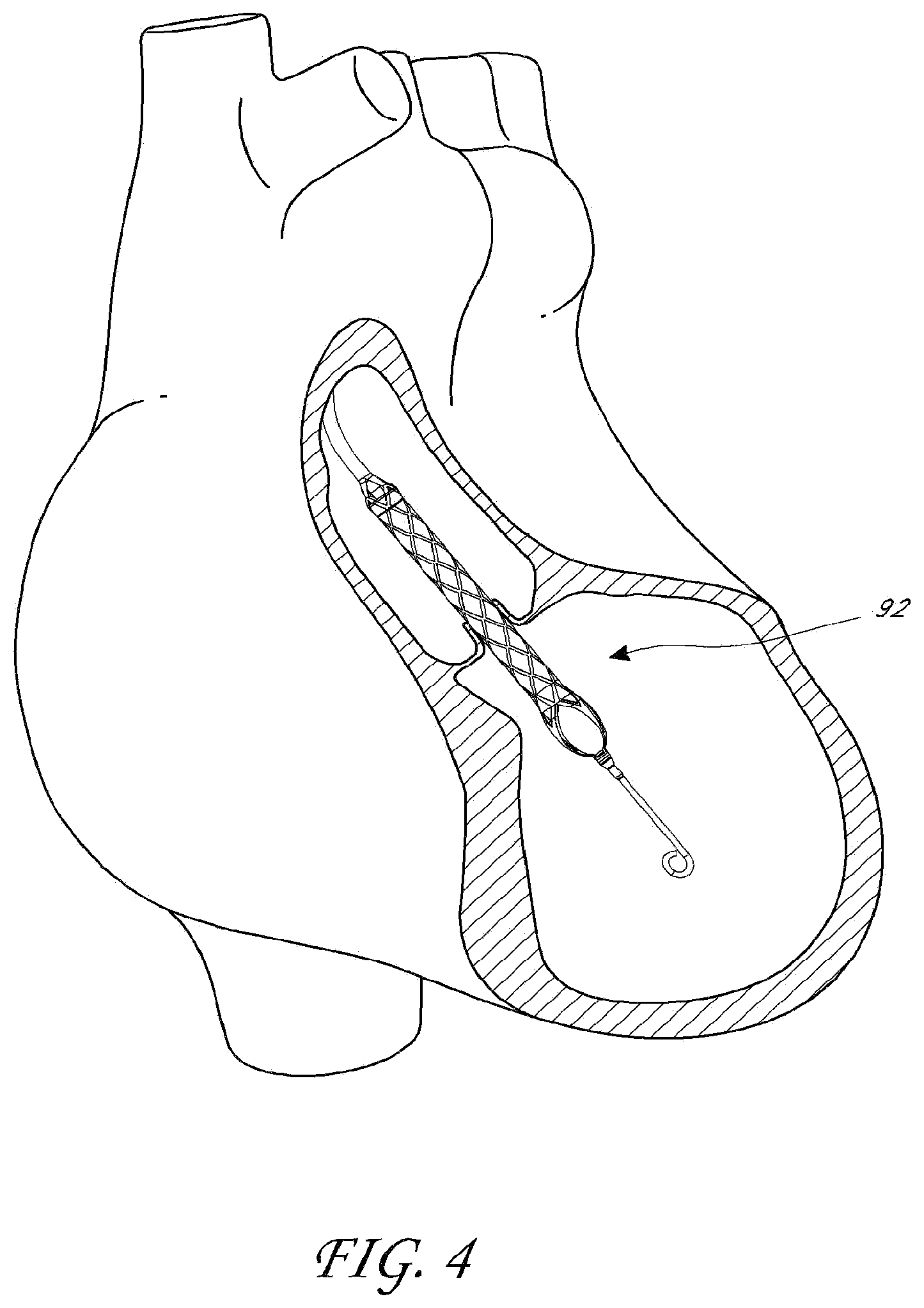 Patent US12569668 Figure 4 – Impeller for catheter pump