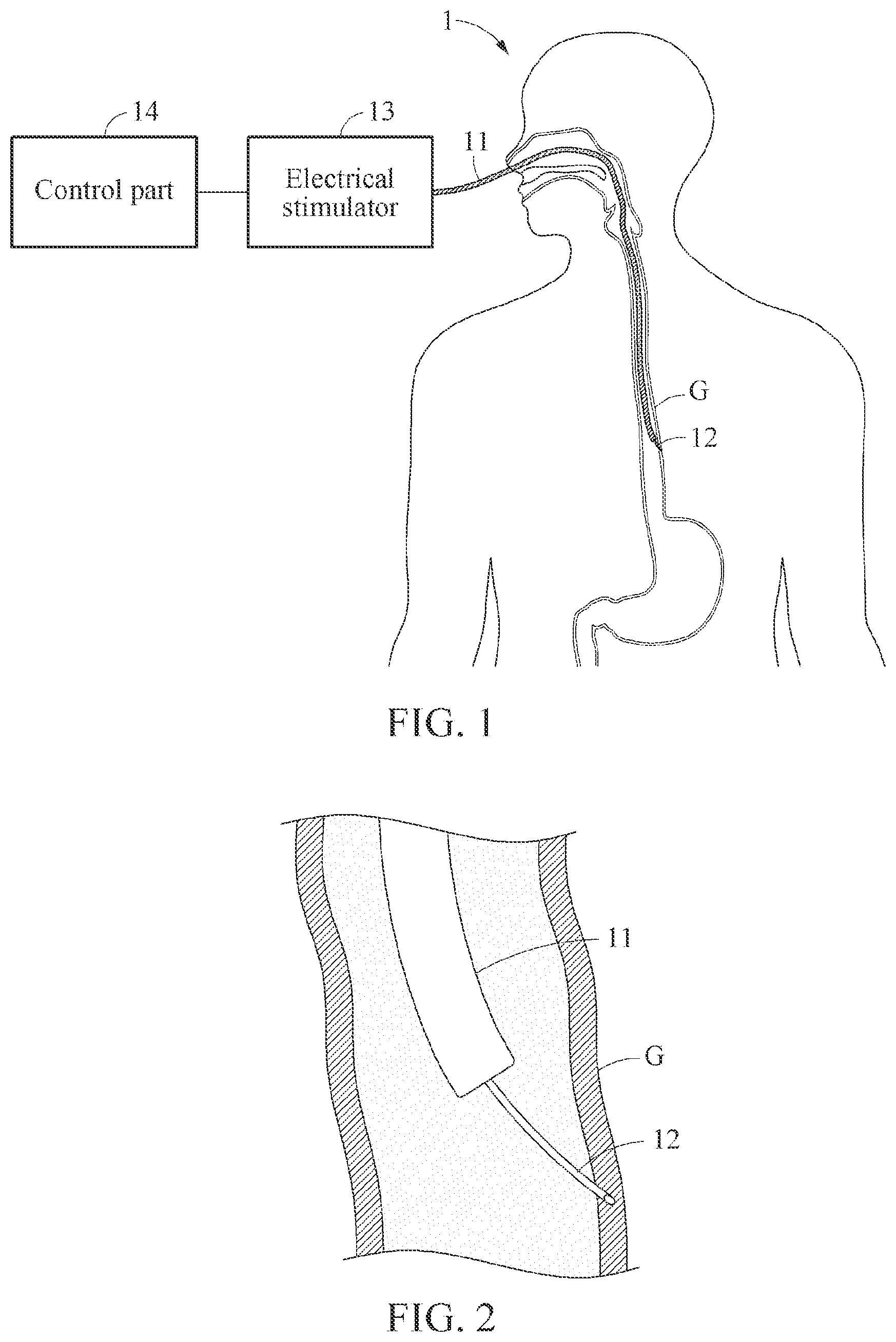 Patent US12569674 Figure 1 – Electrical stimulation system
