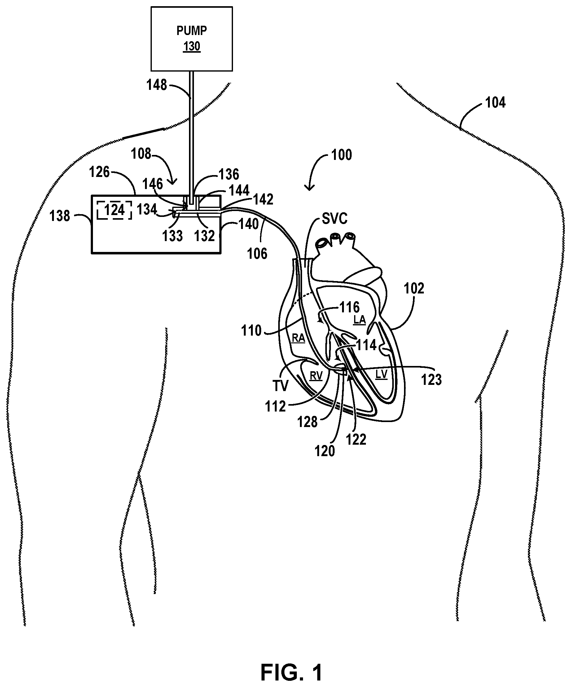 Patent US12569676 Figure 1 – Implantable medical system