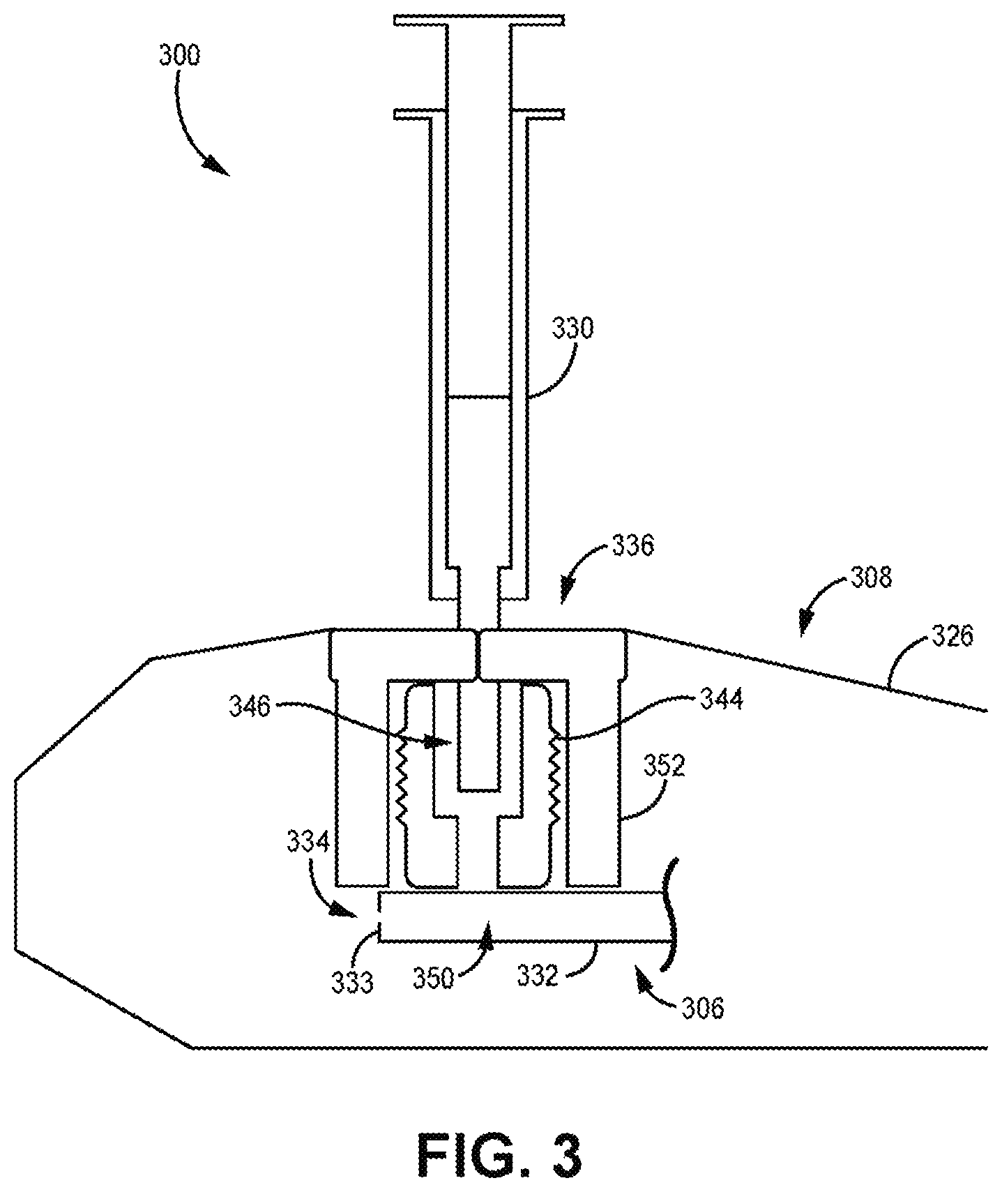 Patent US12569676 Figure 3 – Implantable medical system