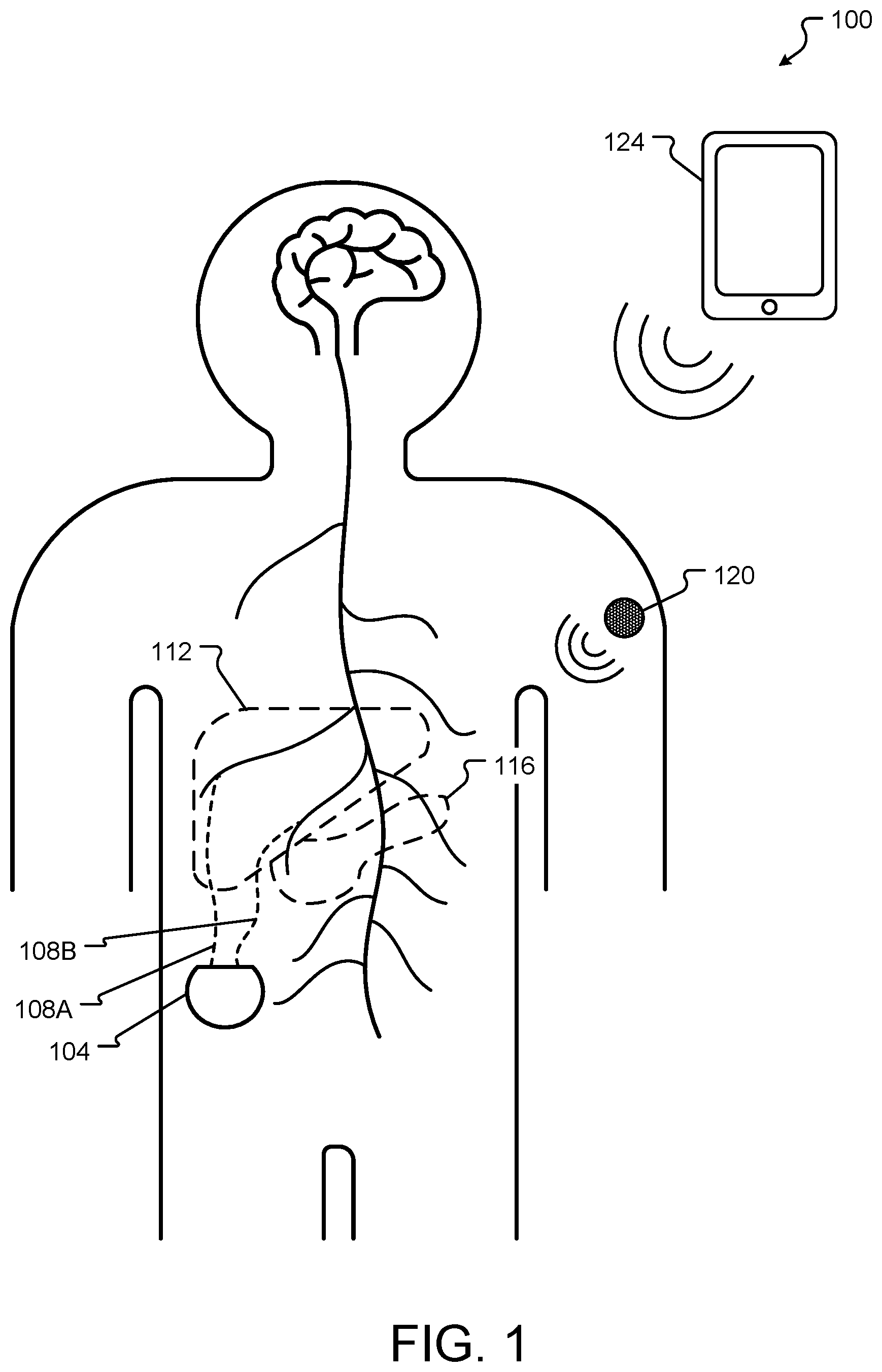 Patent US12569680 Figure 1 – Patient user interface for a stimulation/block therapy for treatment of type 2 diabetes