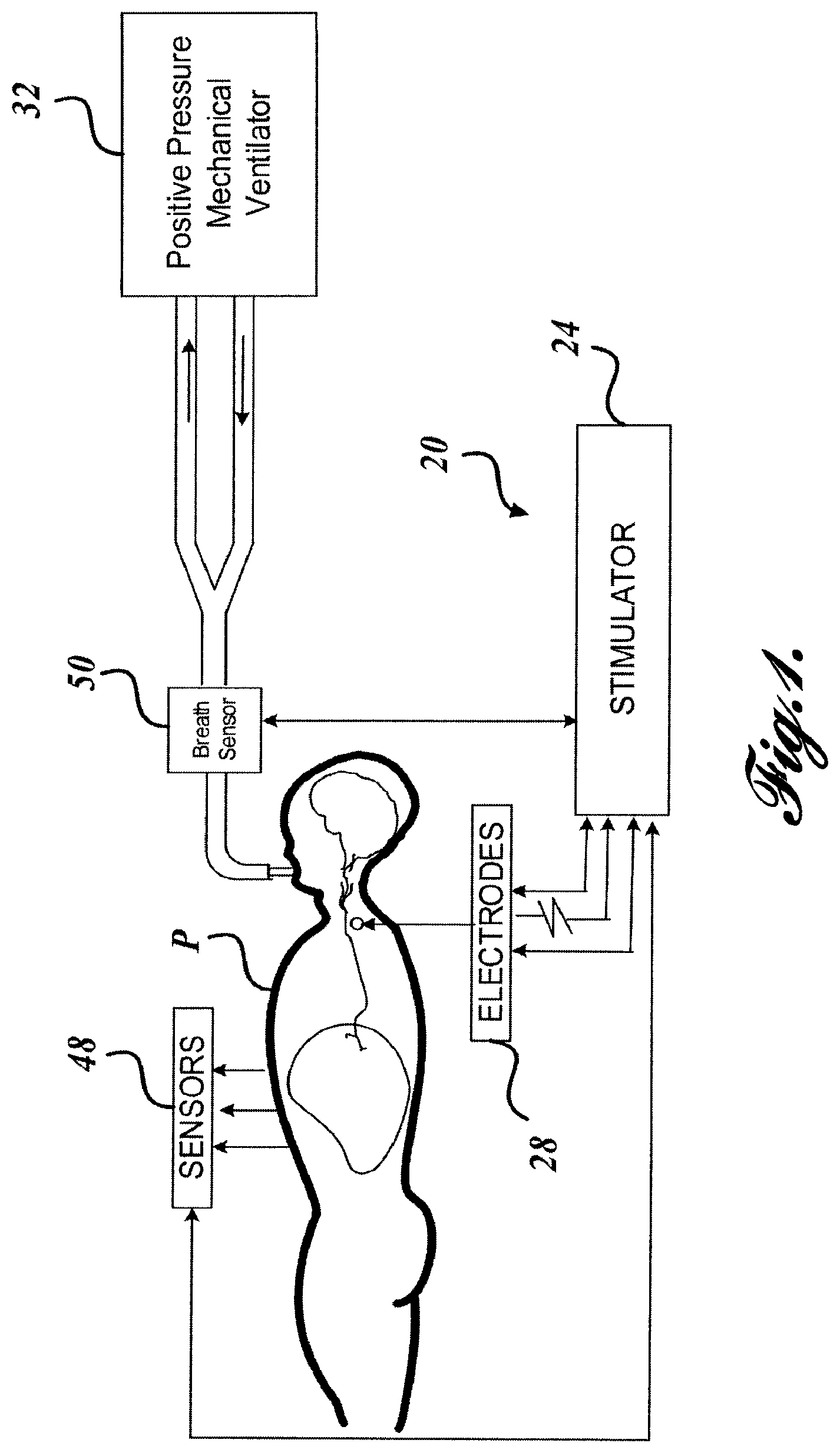 Patent US12569681 Figure 1 – Transvascular diaphragm pacing systems and methods of use