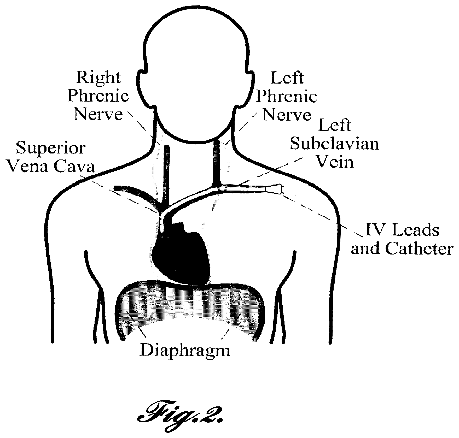 Patent US12569681 Figure 2 – Transvascular diaphragm pacing systems and methods of use