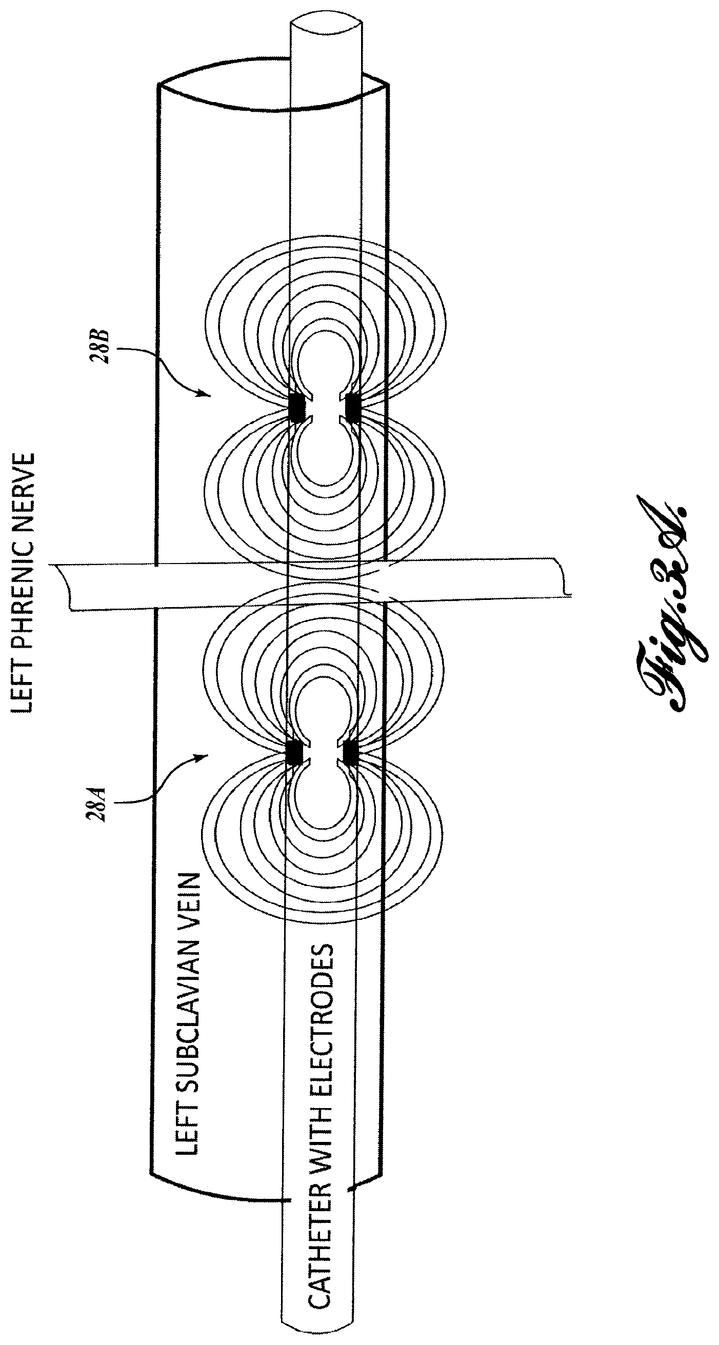 Patent US12569681 Figure 3 – Transvascular diaphragm pacing systems and methods of use