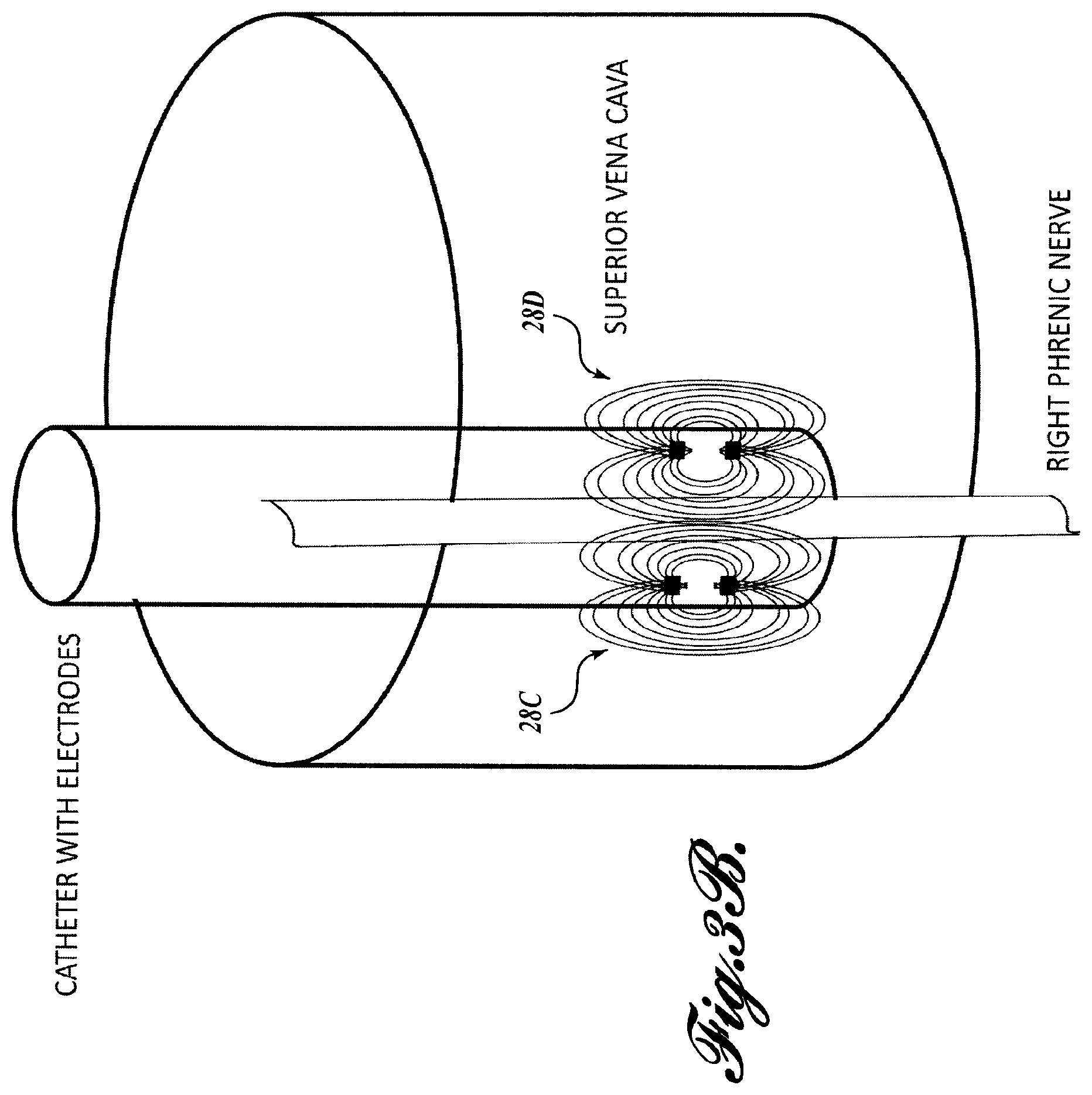 Patent US12569681 Figure 4 – Transvascular diaphragm pacing systems and methods of use
