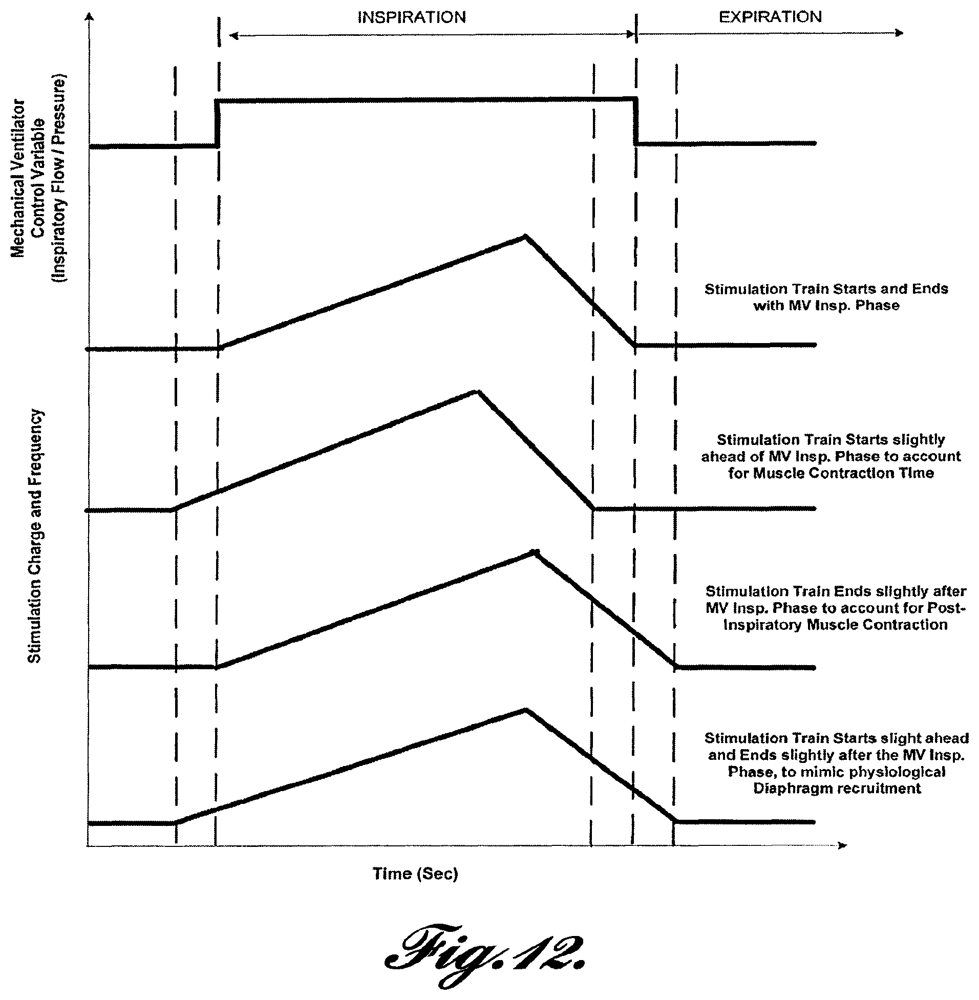Patent US12569681 Figure 11 – Transvascular diaphragm pacing systems and methods of use