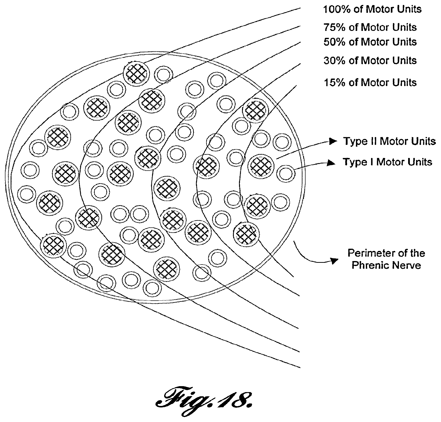 Patent US12569681 Figure 18 – Transvascular diaphragm pacing systems and methods of use