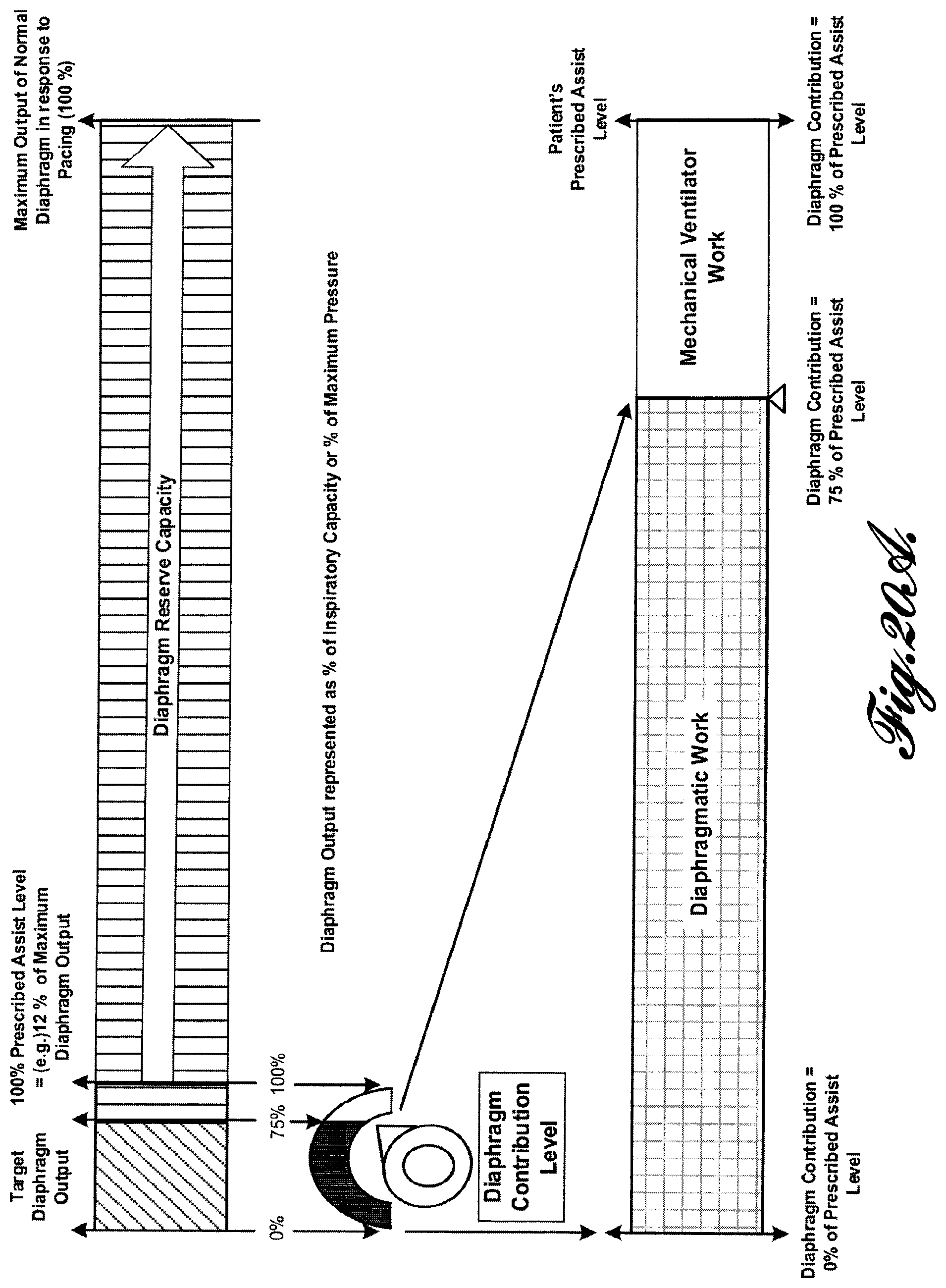 Patent US12569681 Figure 20 – Transvascular diaphragm pacing systems and methods of use