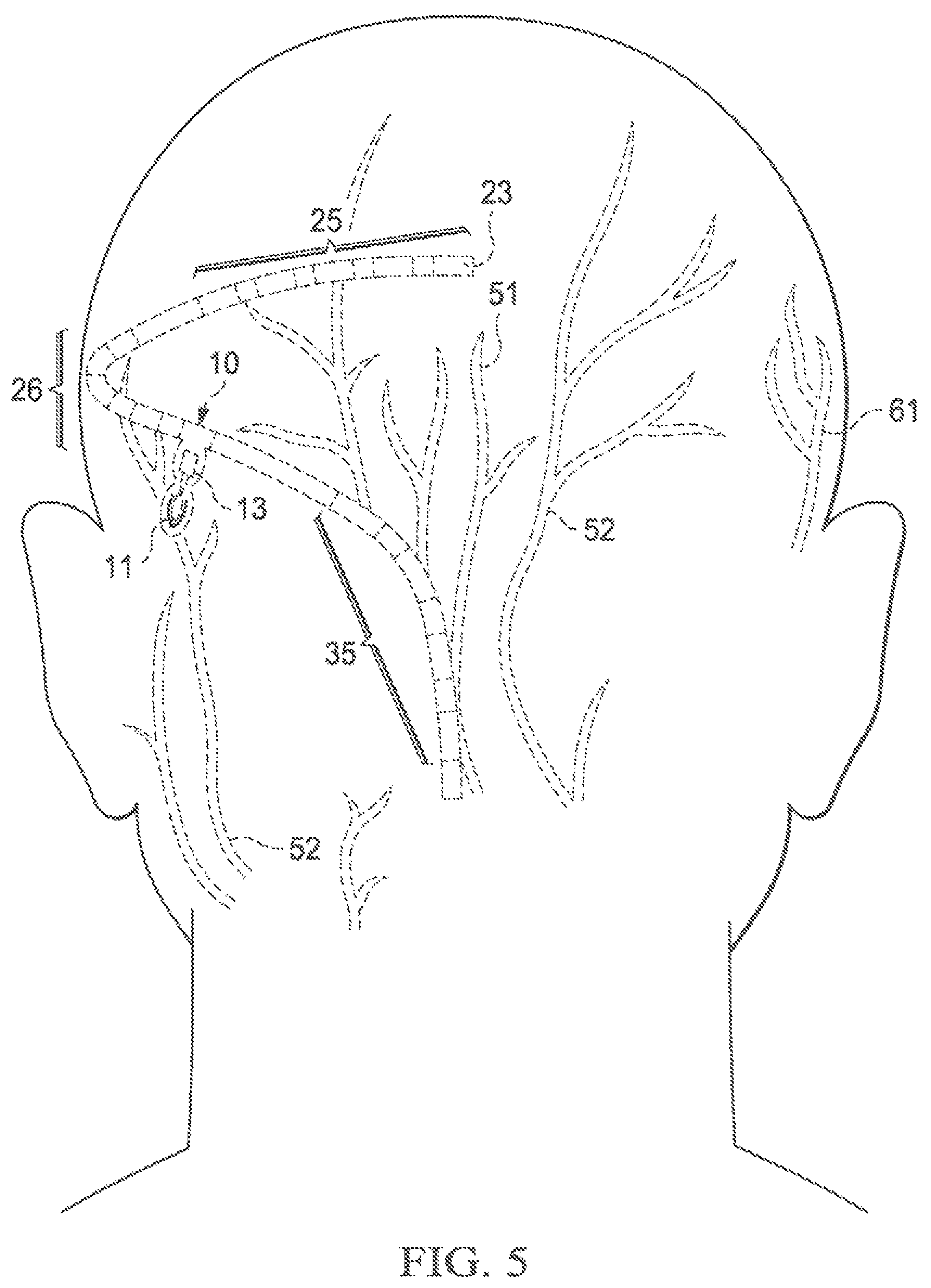 Patent US12569683 Figure 6 – Implantable head located radiofrequency coupled neurostimulation system for head pain