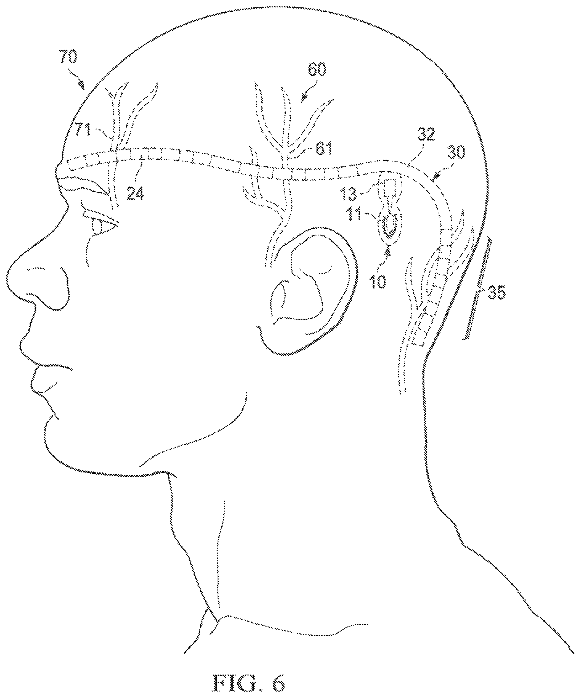 Patent US12569683 Figure 7 – Implantable head located radiofrequency coupled neurostimulation system for head pain