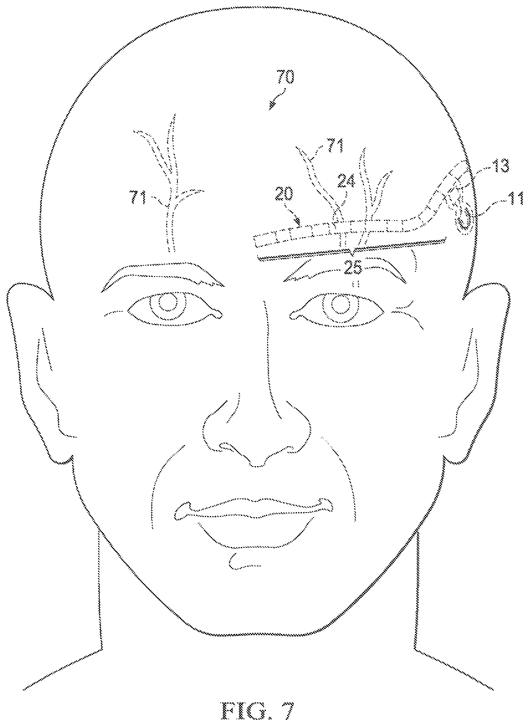 Patent US12569683 Figure 8 – Implantable head located radiofrequency coupled neurostimulation system for head pain