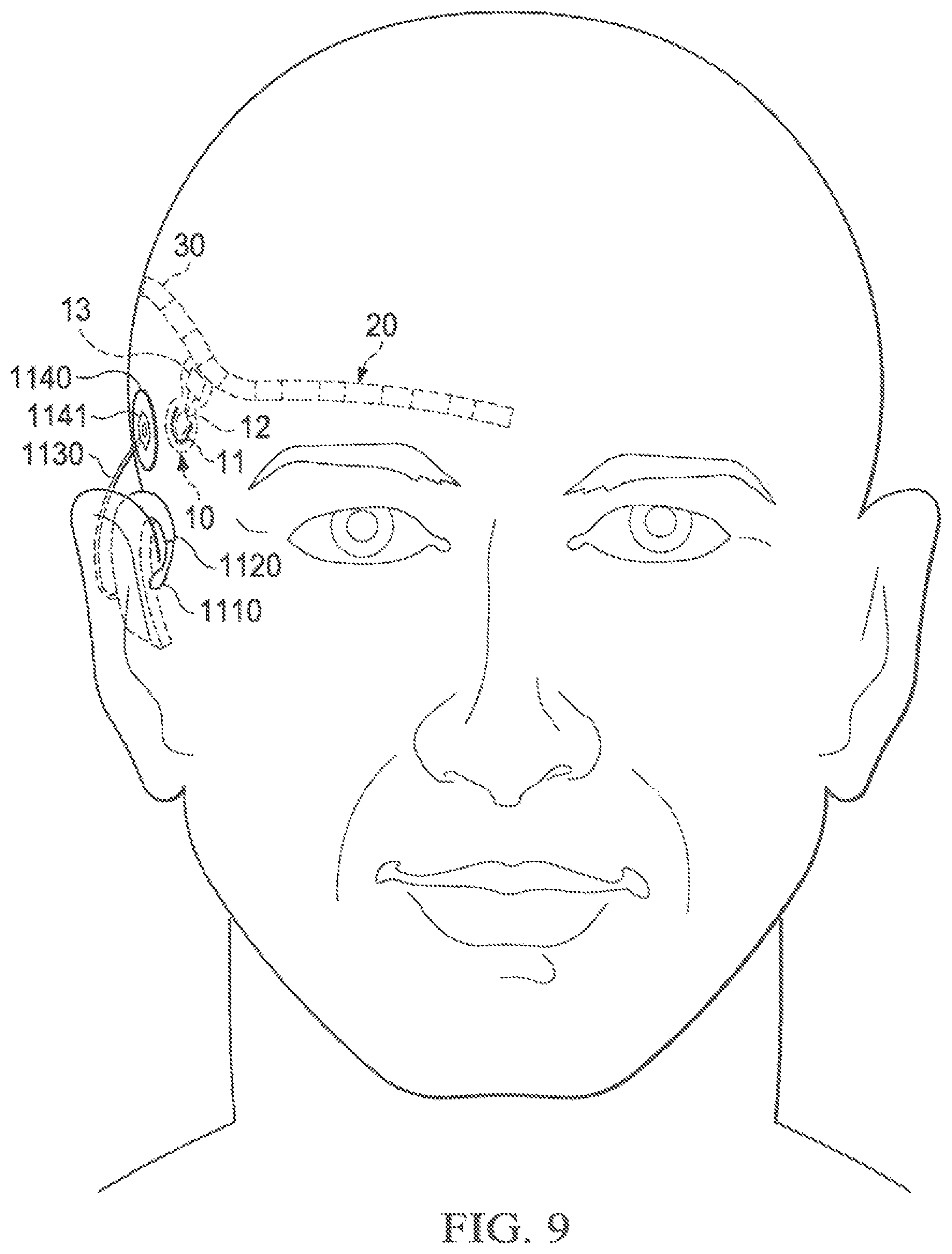Patent US12569683 Figure 10 – Implantable head located radiofrequency coupled neurostimulation system for head pain