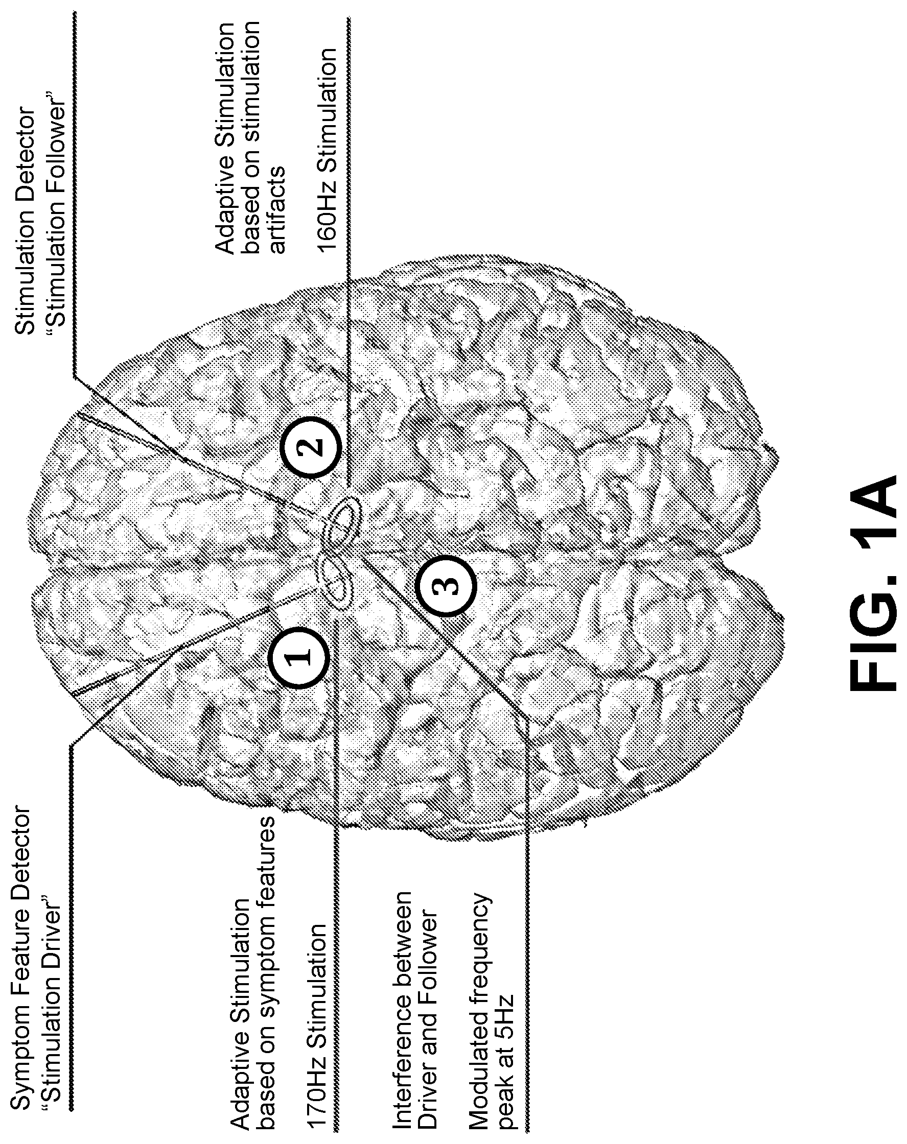 Patent US12569685 Figure 1 – Simultaneous bilateral stimulation using neurostimulator