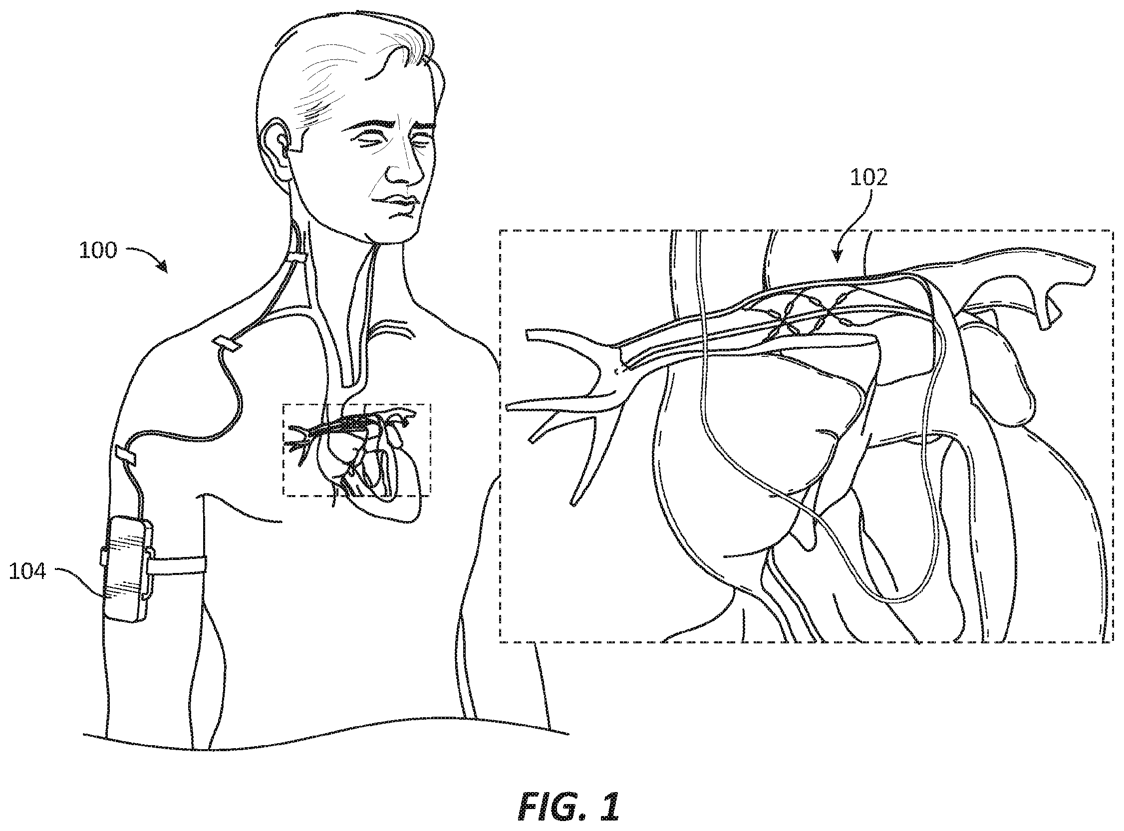 Patent US12569686 Figure 1 – Chronically implantable systems and methods for affecting cardiac contractility and/or relaxation
