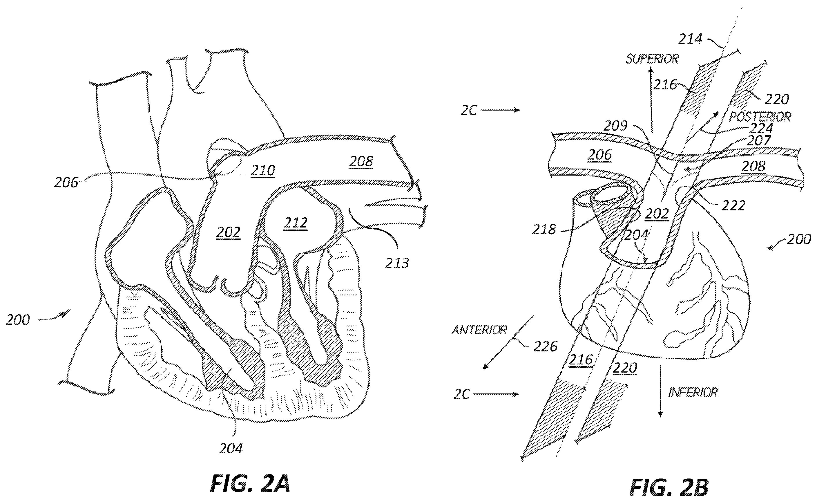 Patent US12569686 Figure 2 – Chronically implantable systems and methods for affecting cardiac contractility and/or relaxation