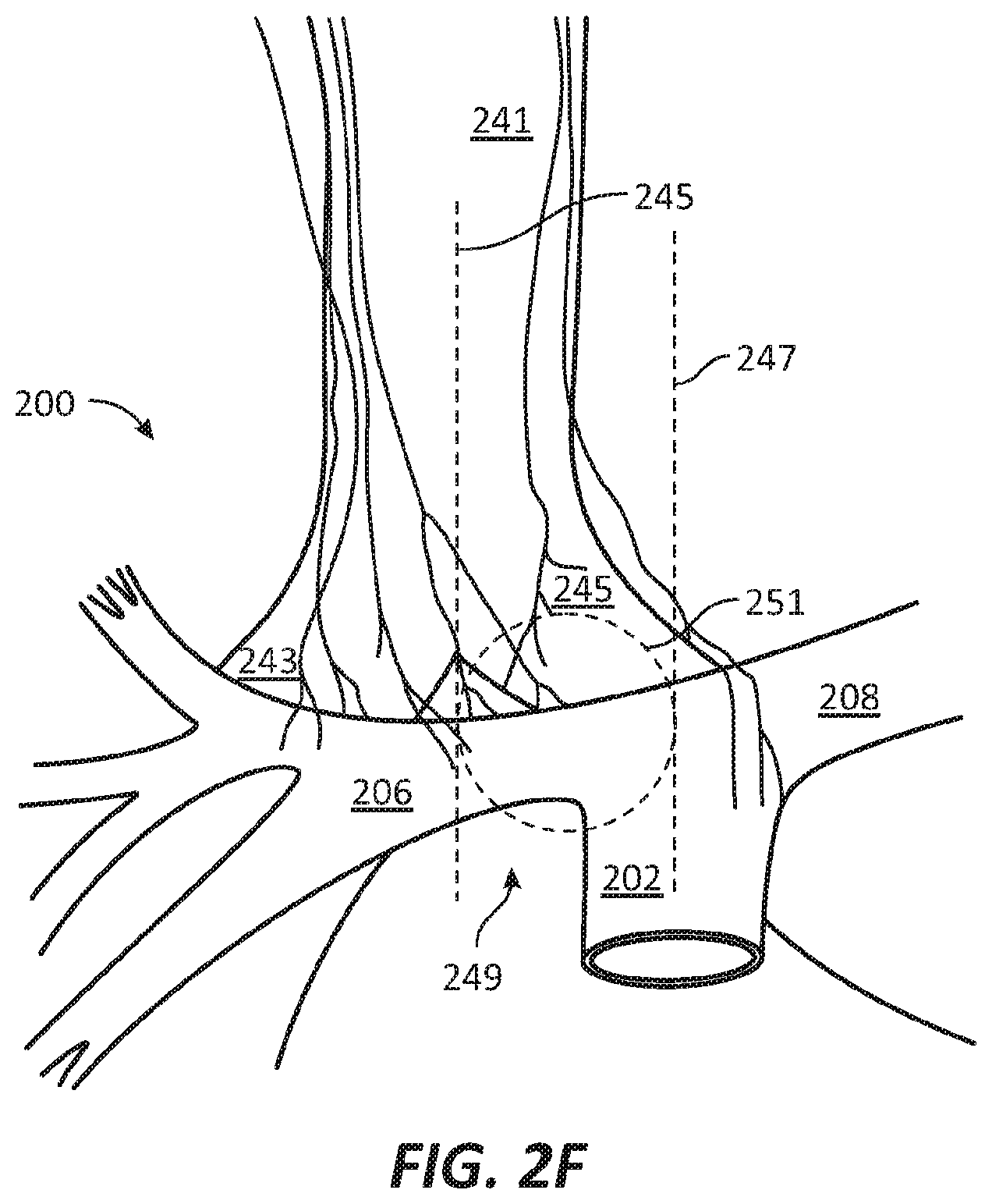 Patent US12569686 Figure 5 – Chronically implantable systems and methods for affecting cardiac contractility and/or relaxation