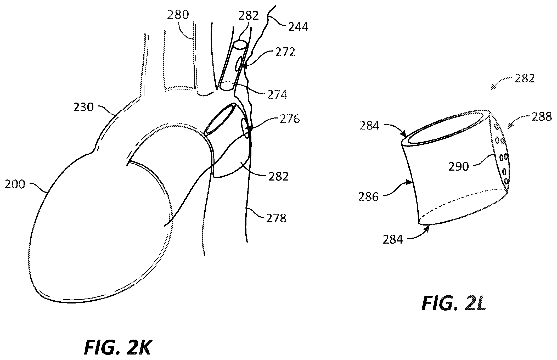 Patent US12569686 Figure 8 – Chronically implantable systems and methods for affecting cardiac contractility and/or relaxation