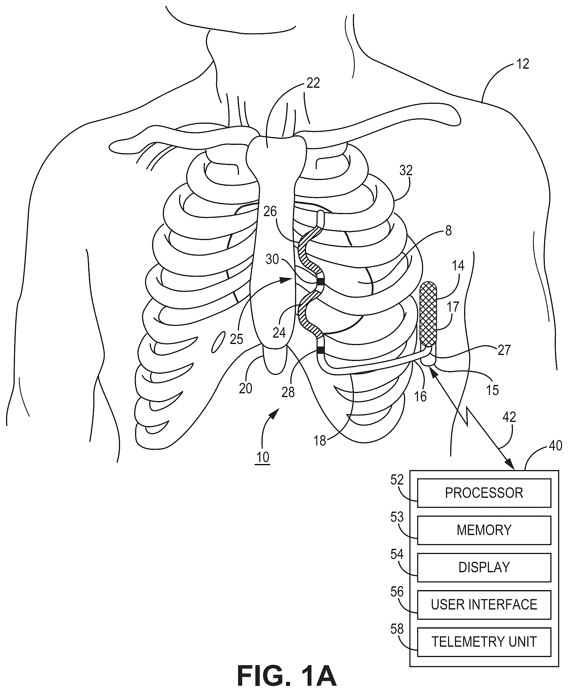 Patent US12569688 Figure 1 – Medical device and method for detecting arrhythmia