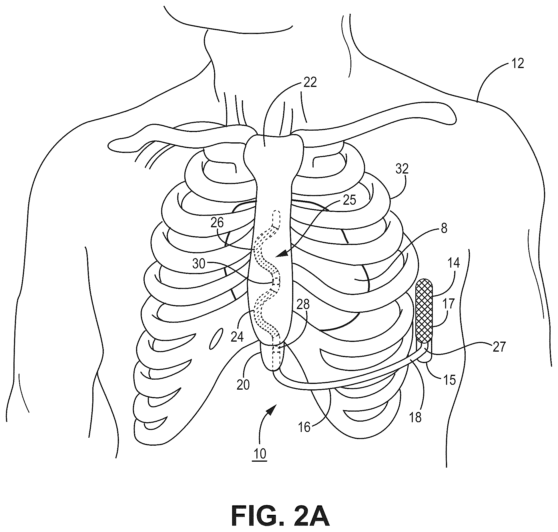 Patent US12569688 Figure 3 – Medical device and method for detecting arrhythmia