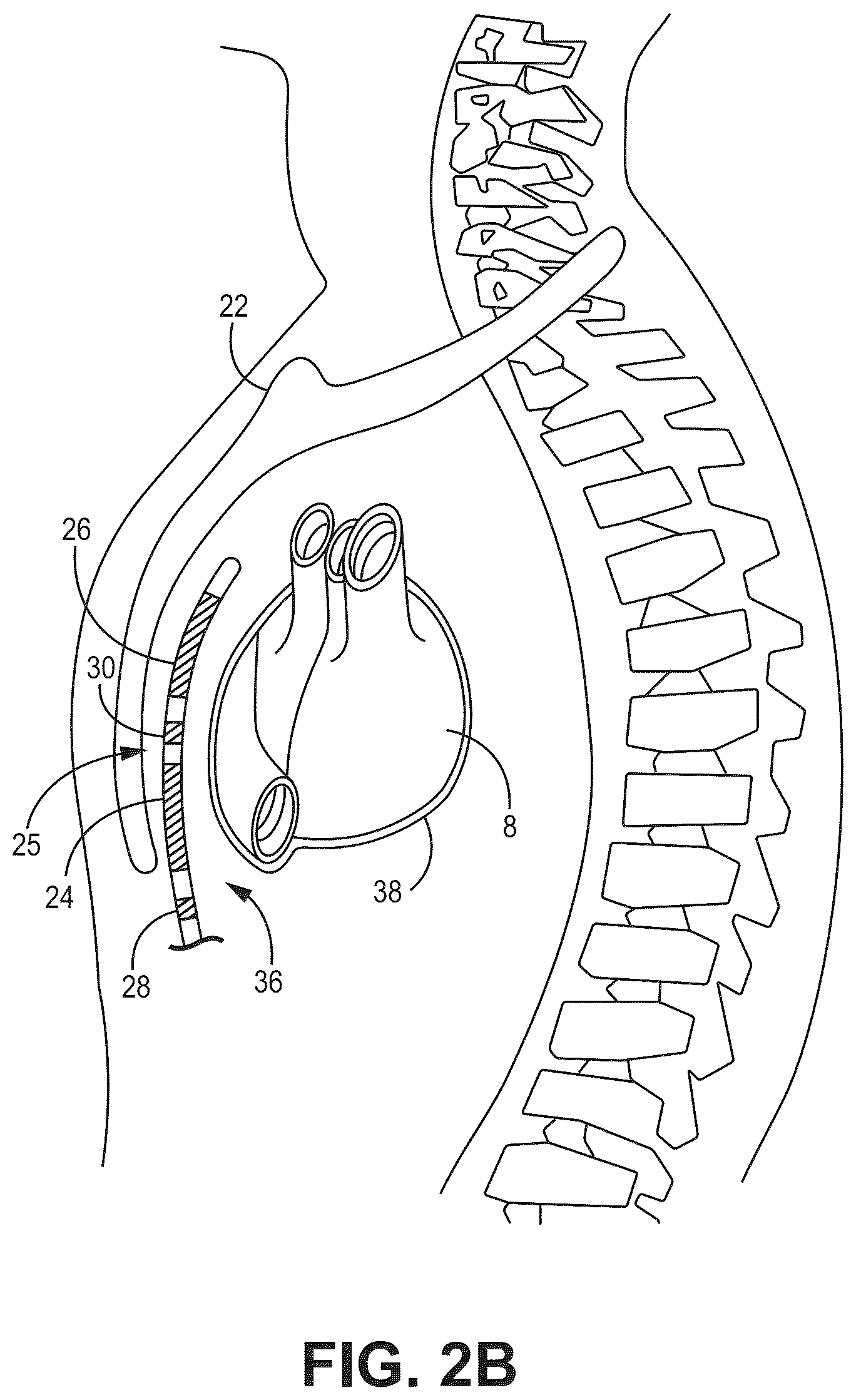 Patent US12569688 Figure 4 – Medical device and method for detecting arrhythmia