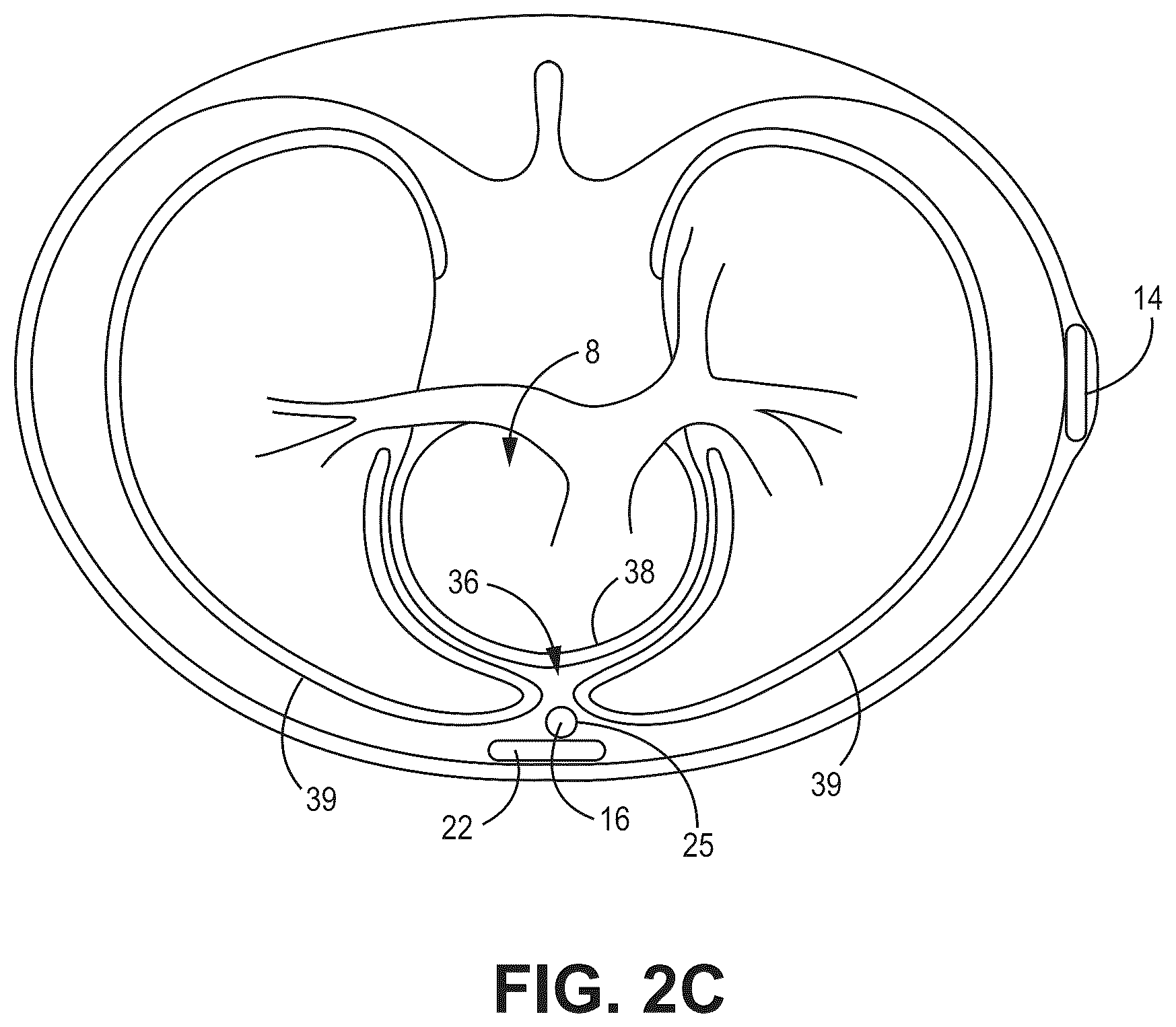 Patent US12569688 Figure 5 – Medical device and method for detecting arrhythmia