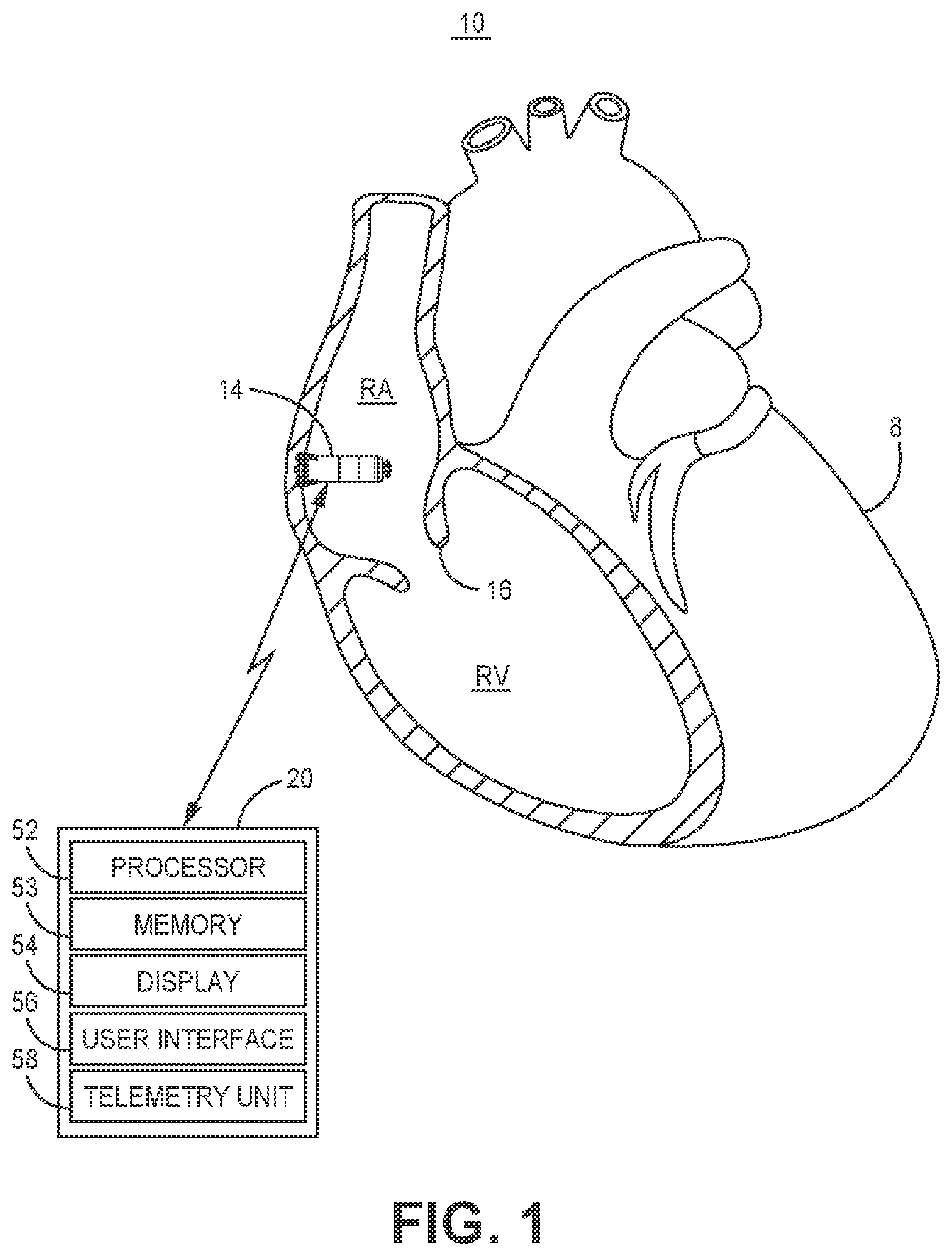 Patent US12569689 Figure 1 – Medical device and method for detecting atrioventricular block