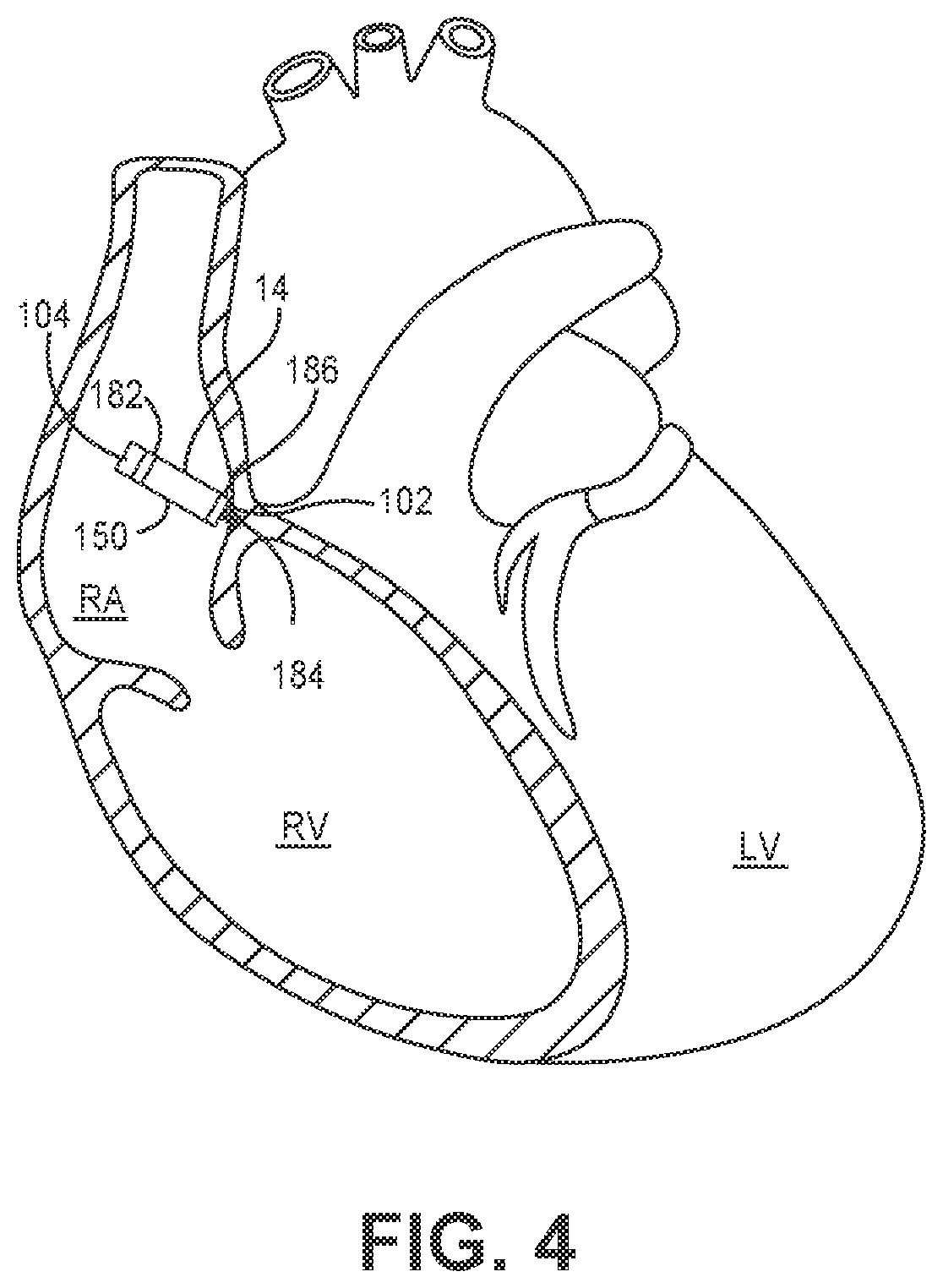 Patent US12569689 Figure 3 – Medical device and method for detecting atrioventricular block