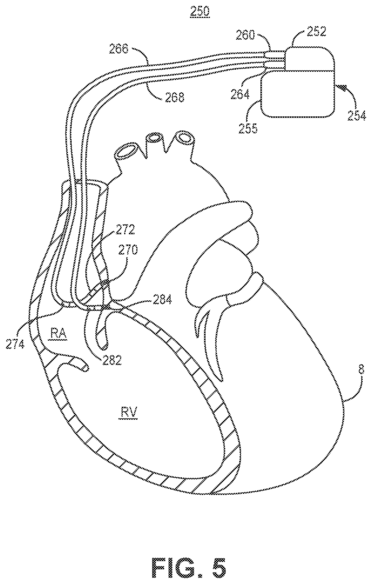 Patent US12569689 Figure 4 – Medical device and method for detecting atrioventricular block