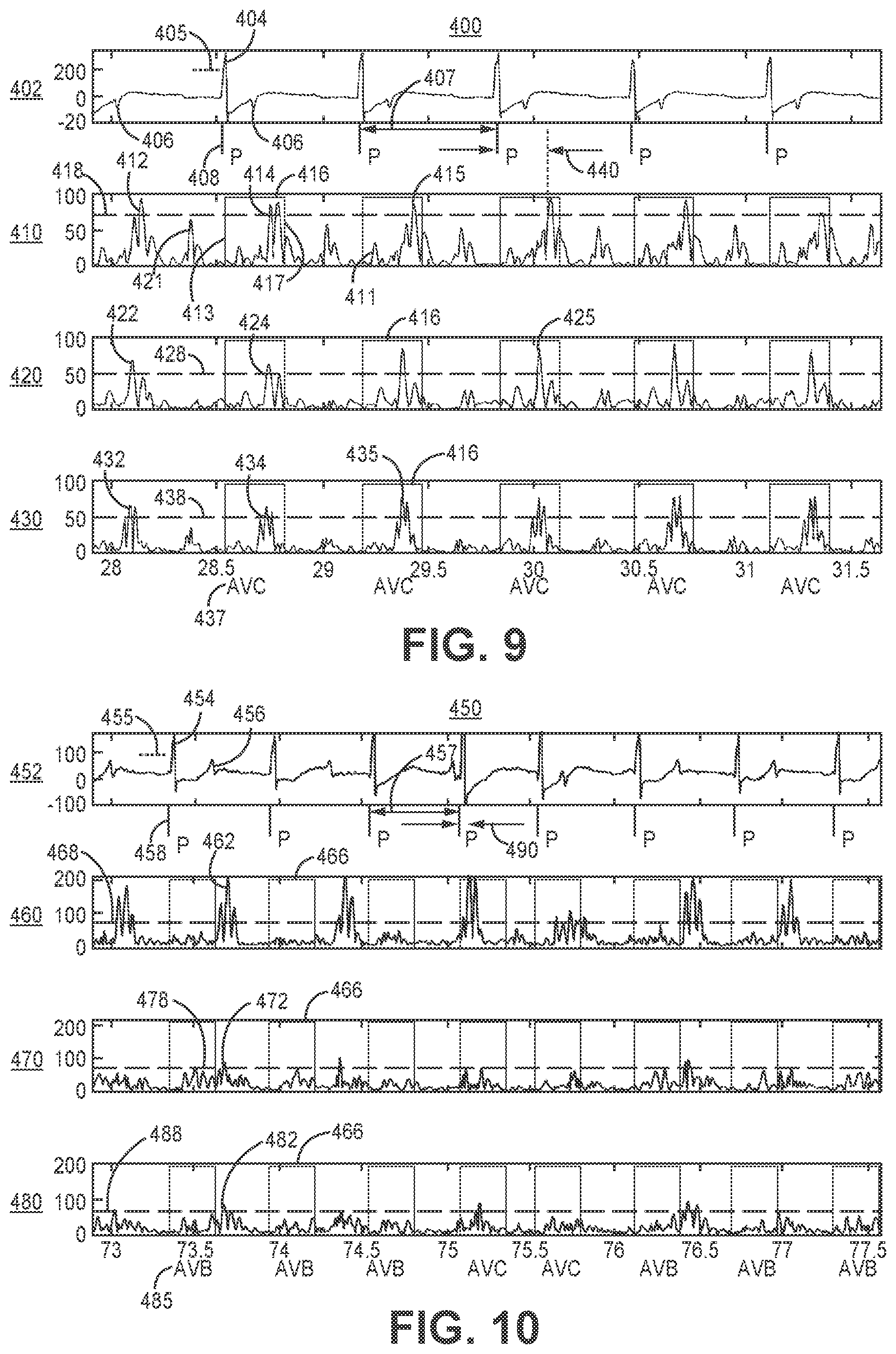 Patent US12569689 Figure 8 – Medical device and method for detecting atrioventricular block