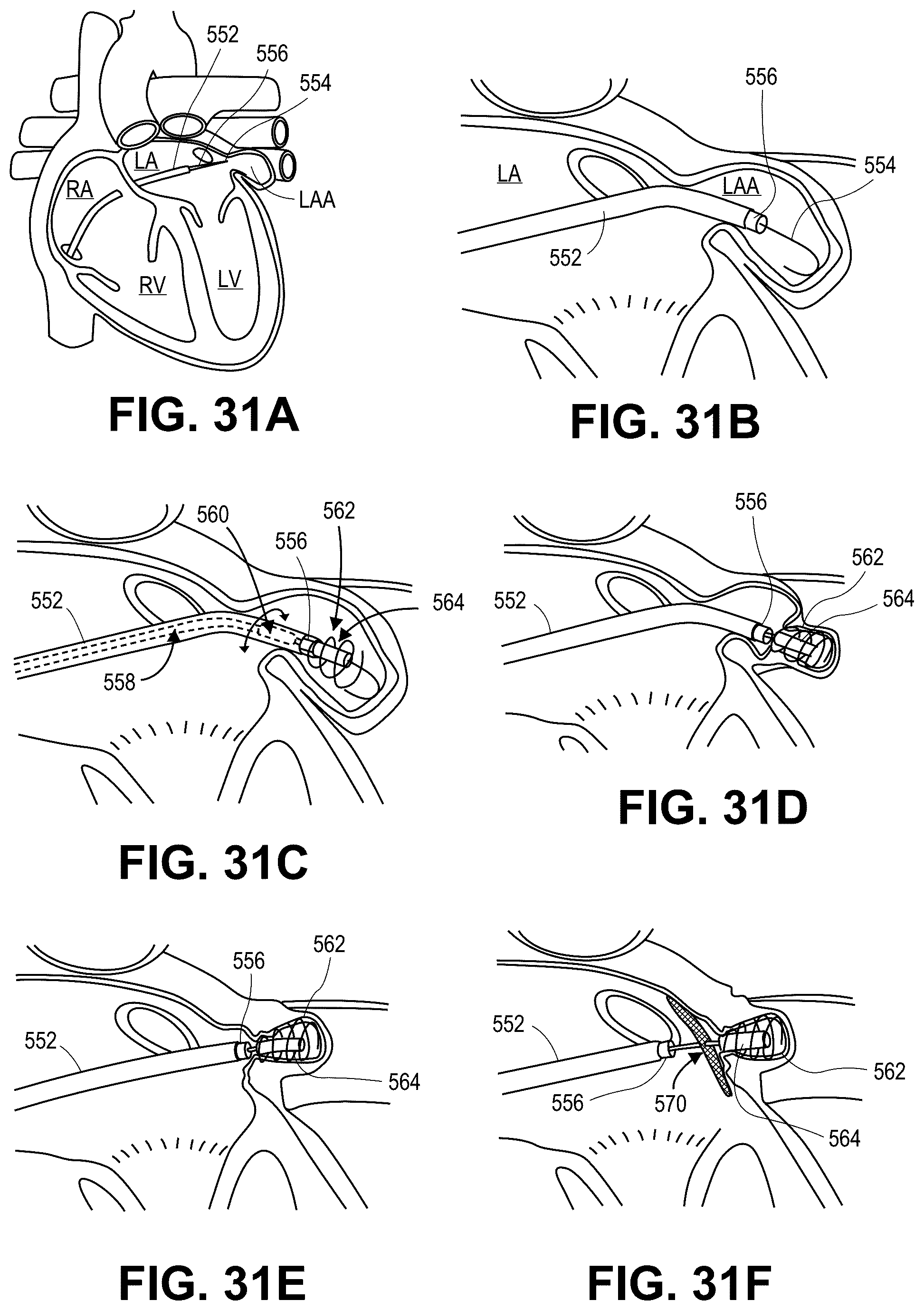 Patent US12569691 Figure 14 – Atrial appendage occlusion and arrhythmia tratment