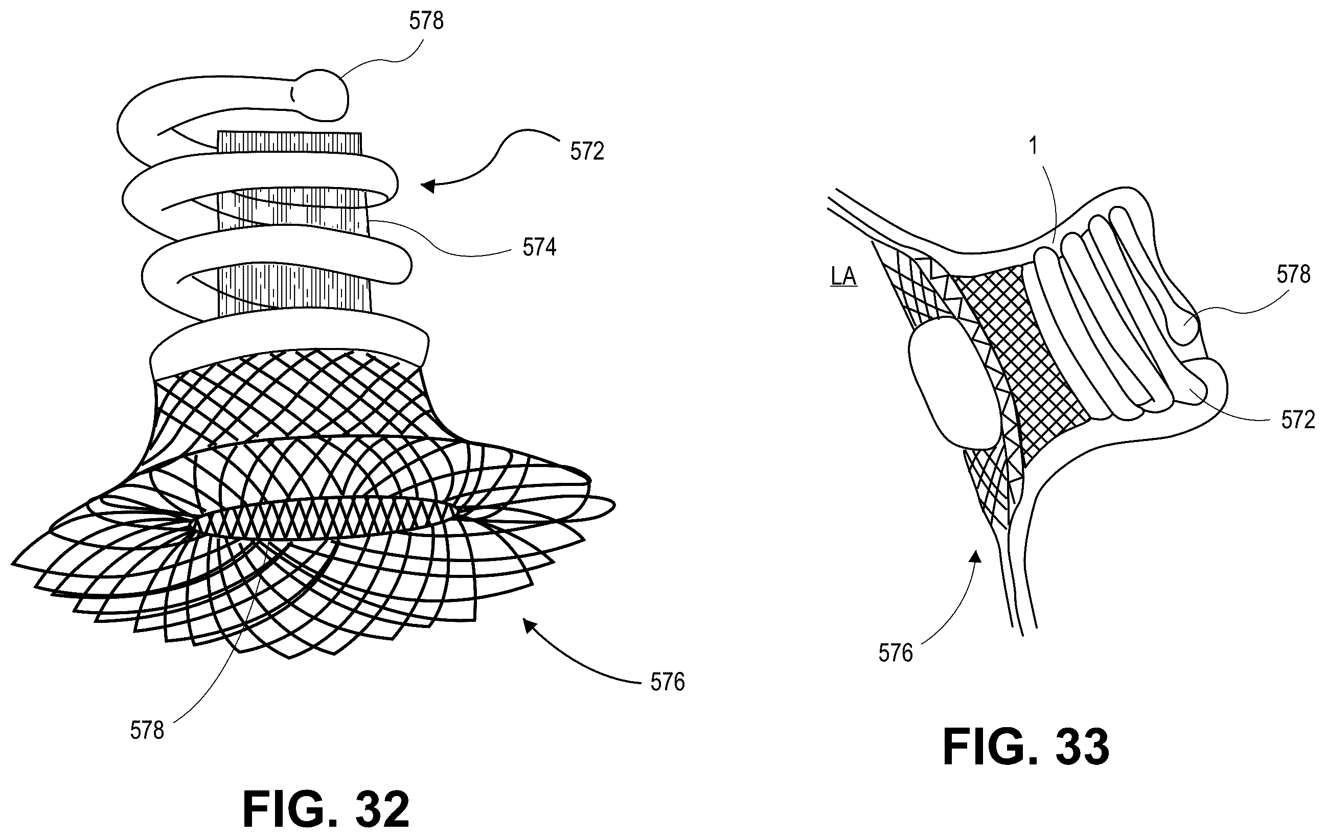 Patent US12569691 Figure 15 – Atrial appendage occlusion and arrhythmia tratment