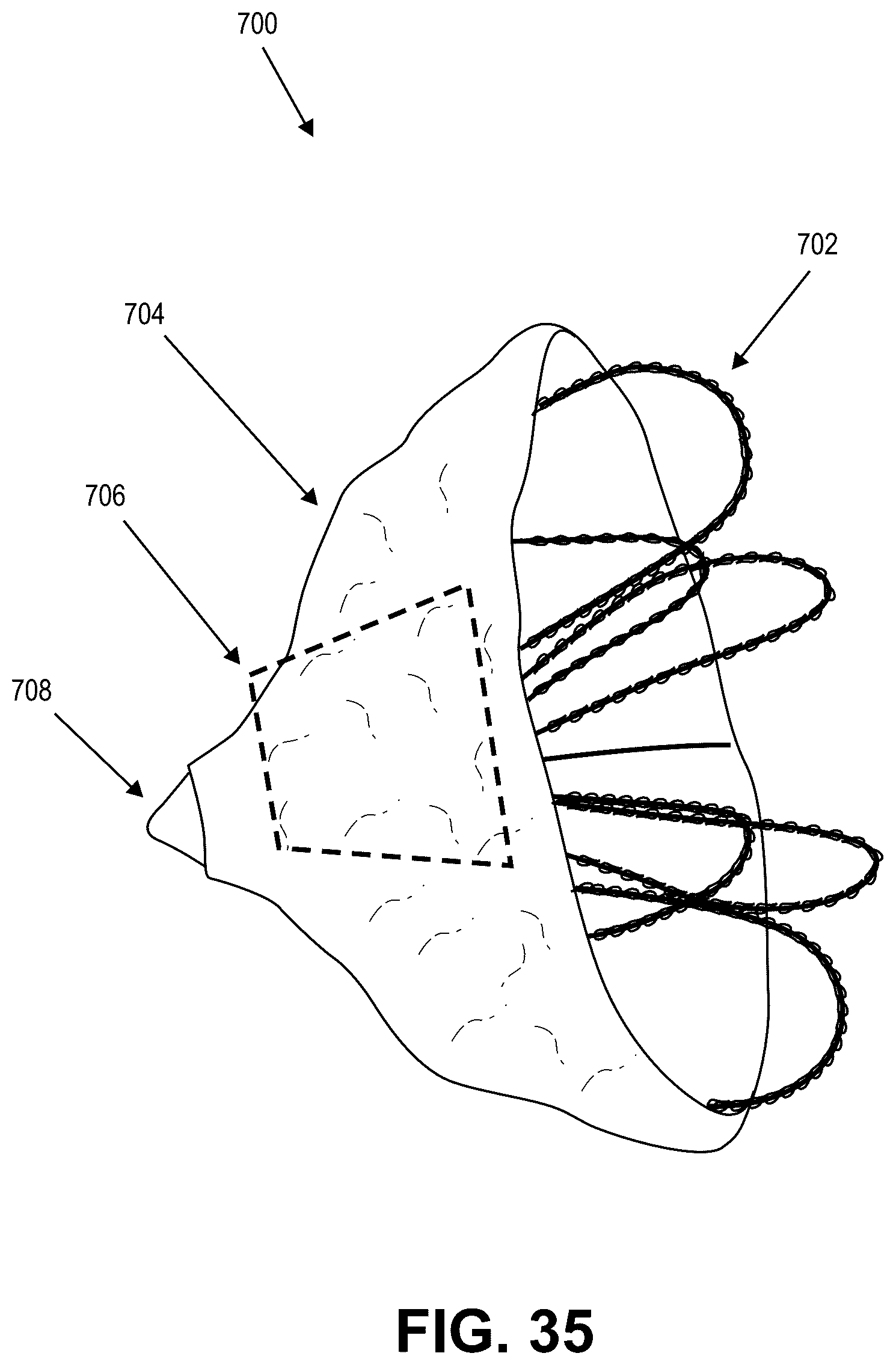 Patent US12569691 Figure 17 – Atrial appendage occlusion and arrhythmia tratment