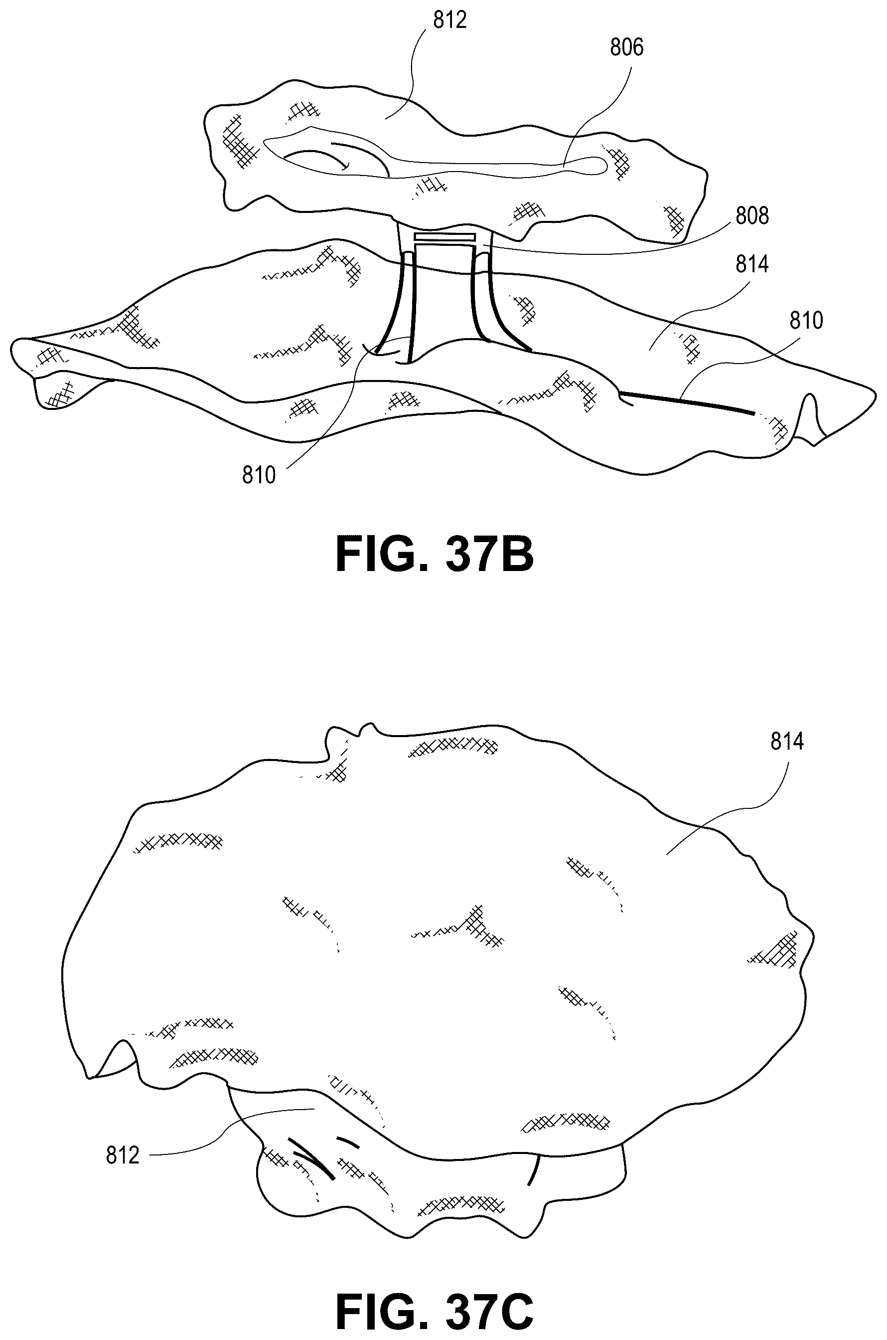 Patent US12569691 Figure 20 – Atrial appendage occlusion and arrhythmia tratment