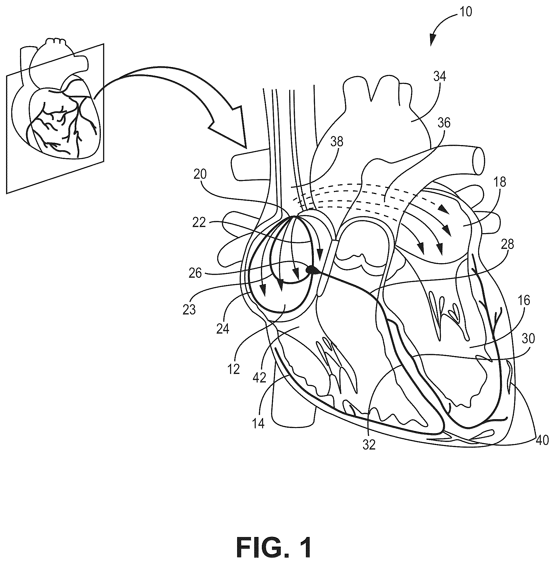 Patent US12569694 Figure 1 – Adjustable lead systems for cardiac septal wall implantation