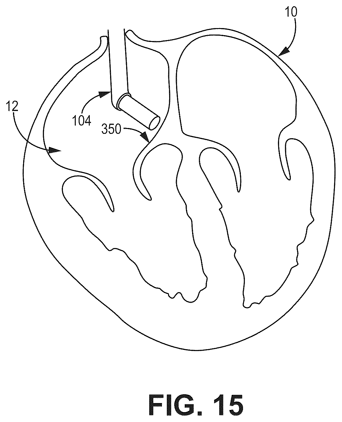 Patent US12569694 Figure 14 – Adjustable lead systems for cardiac septal wall implantation