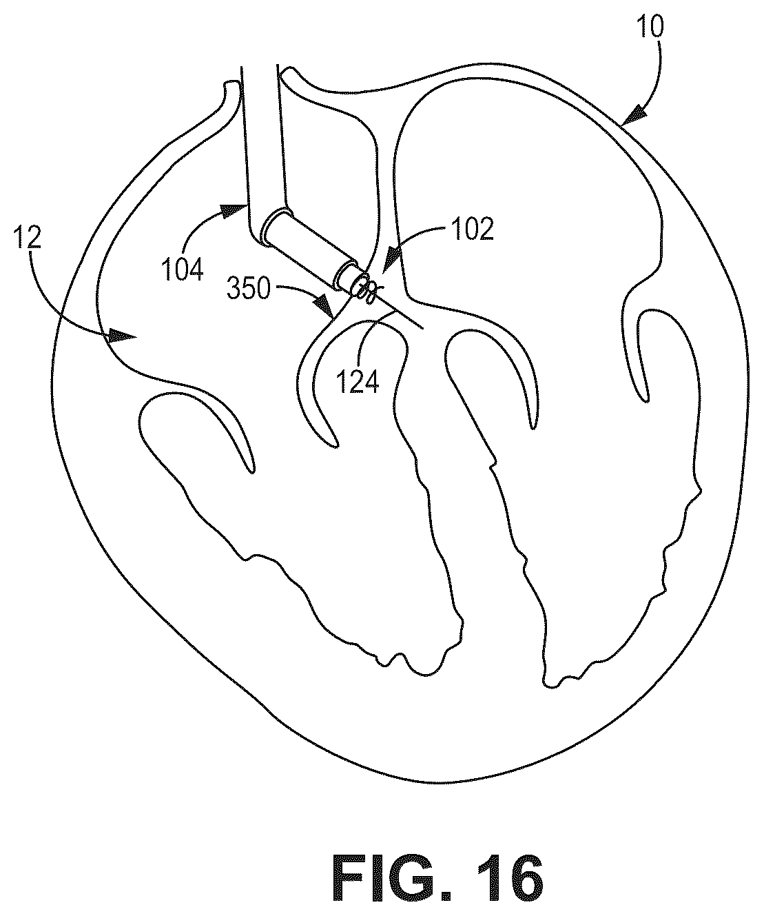 Patent US12569694 Figure 15 – Adjustable lead systems for cardiac septal wall implantation