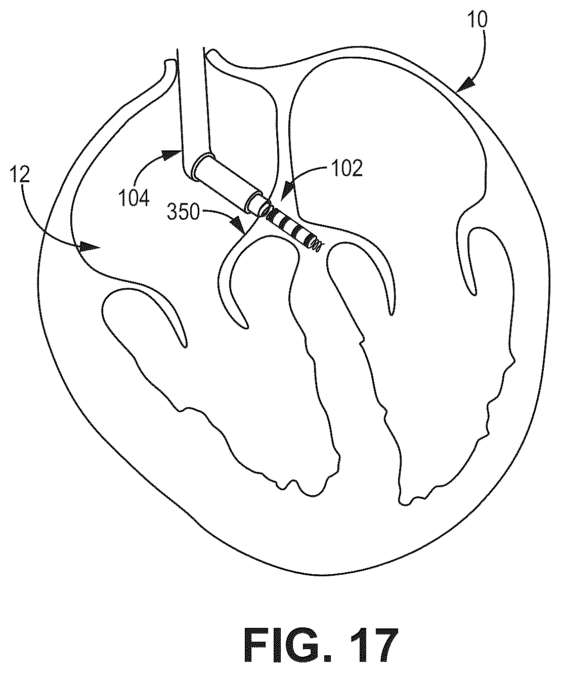 Patent US12569694 Figure 16 – Adjustable lead systems for cardiac septal wall implantation