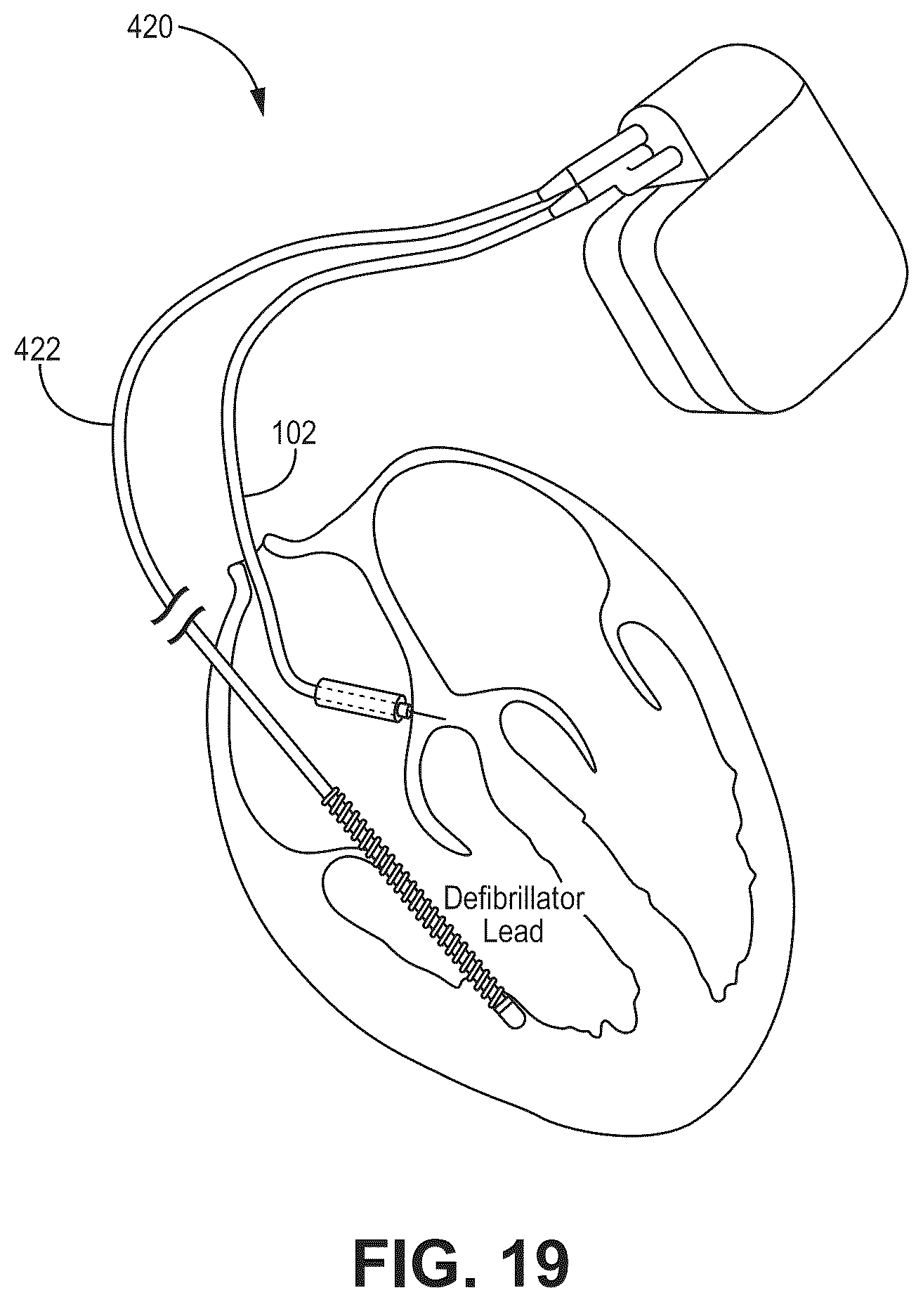 Patent US12569694 Figure 18 – Adjustable lead systems for cardiac septal wall implantation