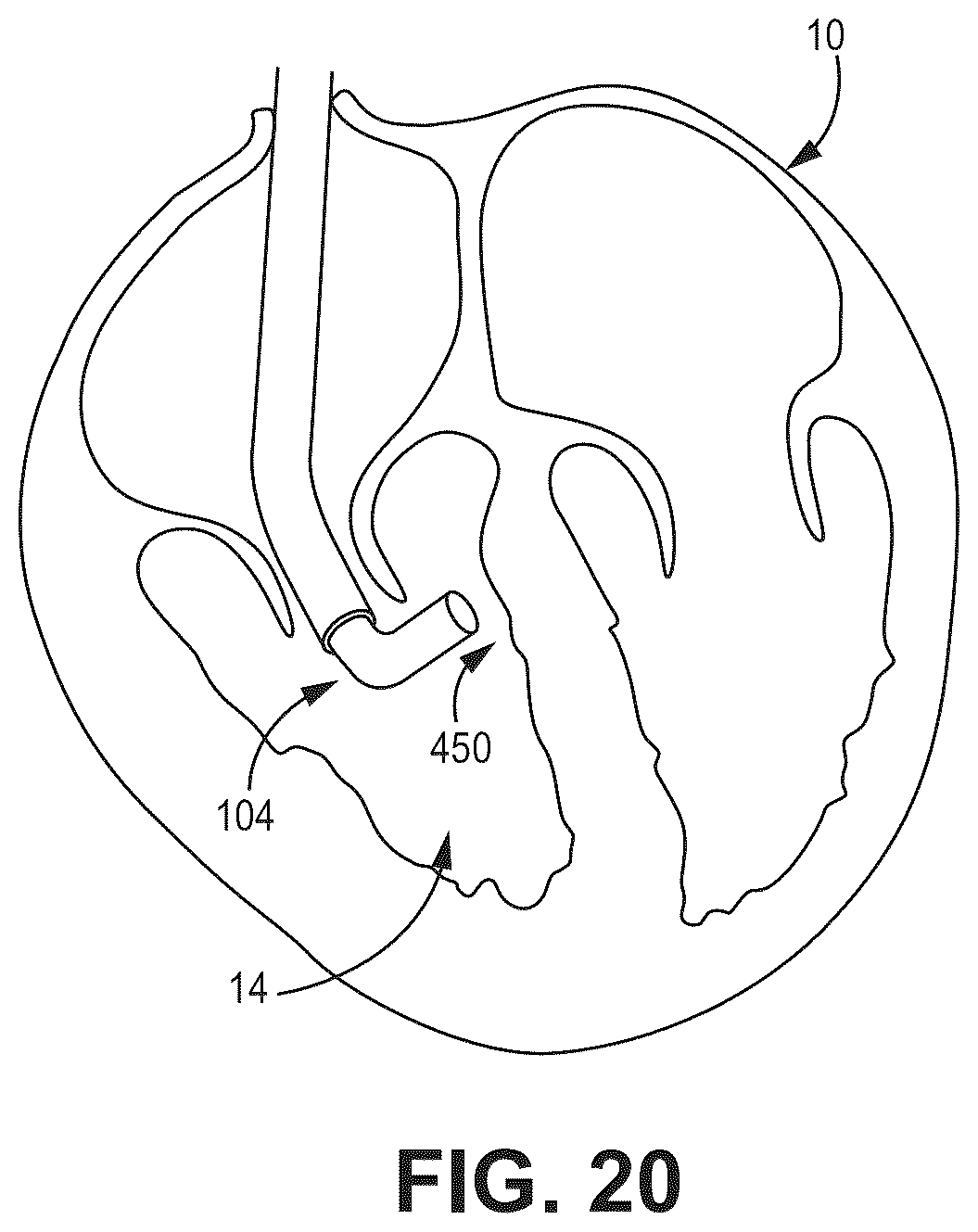 Patent US12569694 Figure 19 – Adjustable lead systems for cardiac septal wall implantation