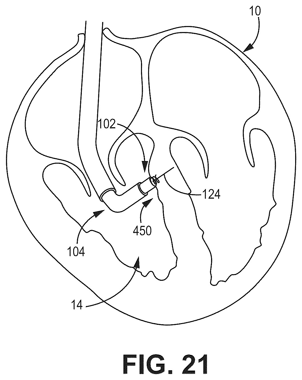 Patent US12569694 Figure 20 – Adjustable lead systems for cardiac septal wall implantation